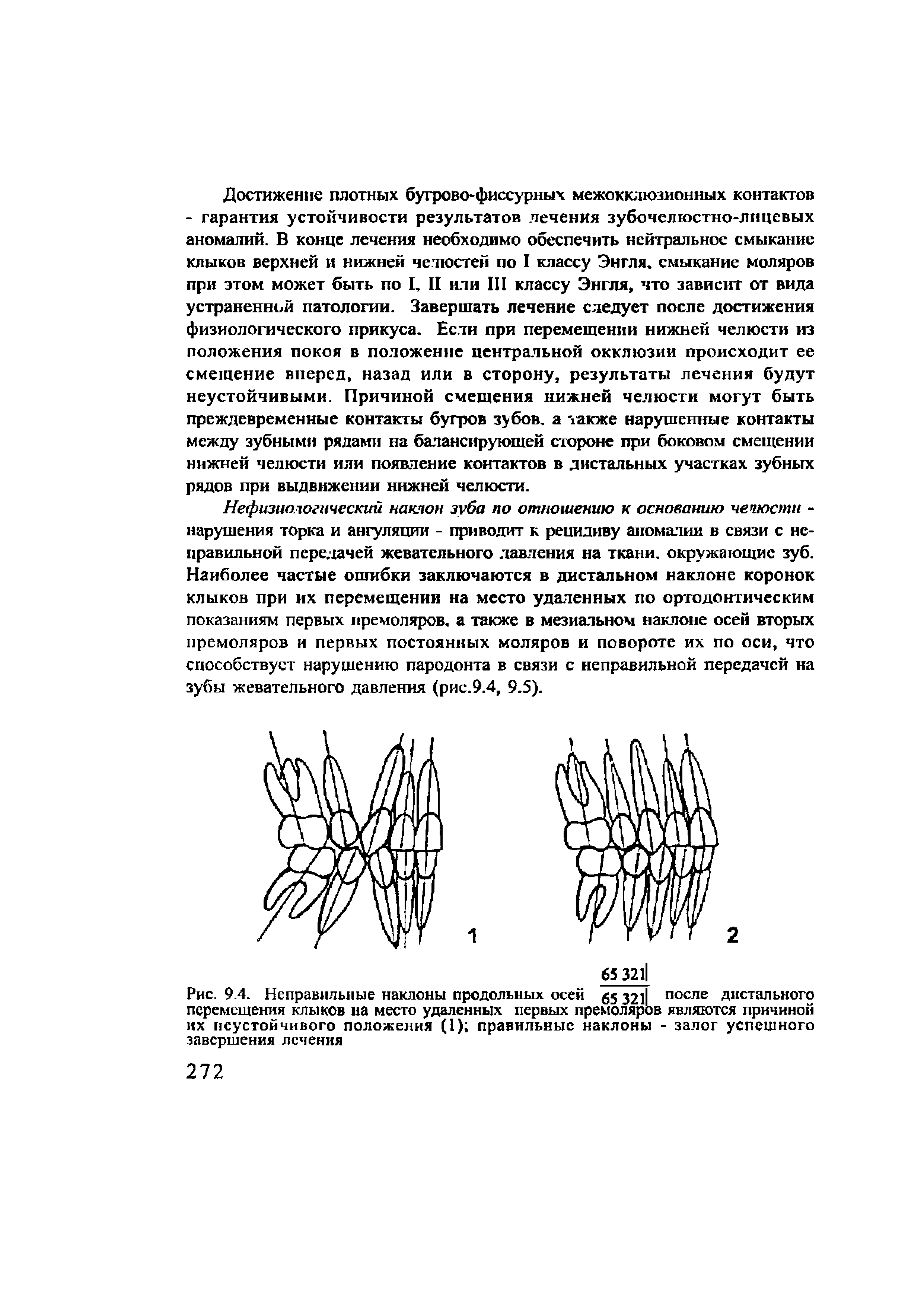 Рис. 9.4. Неправильные наклоны продольных осей де 321 П()сле дистального перемещения клыков на место удаленных первых премоляров являются причиной их неустойчивого положения (1) правильные наклоны - залог успешного завершения лечения...