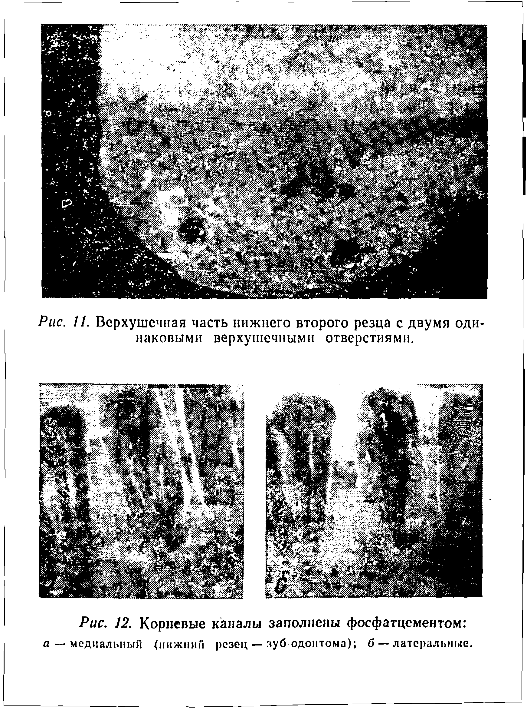 Рис. 12. Корневые каналы заполнены фосфатцементом а — медиальный (нижний резец —зуб-одонтома) б — латеральные.