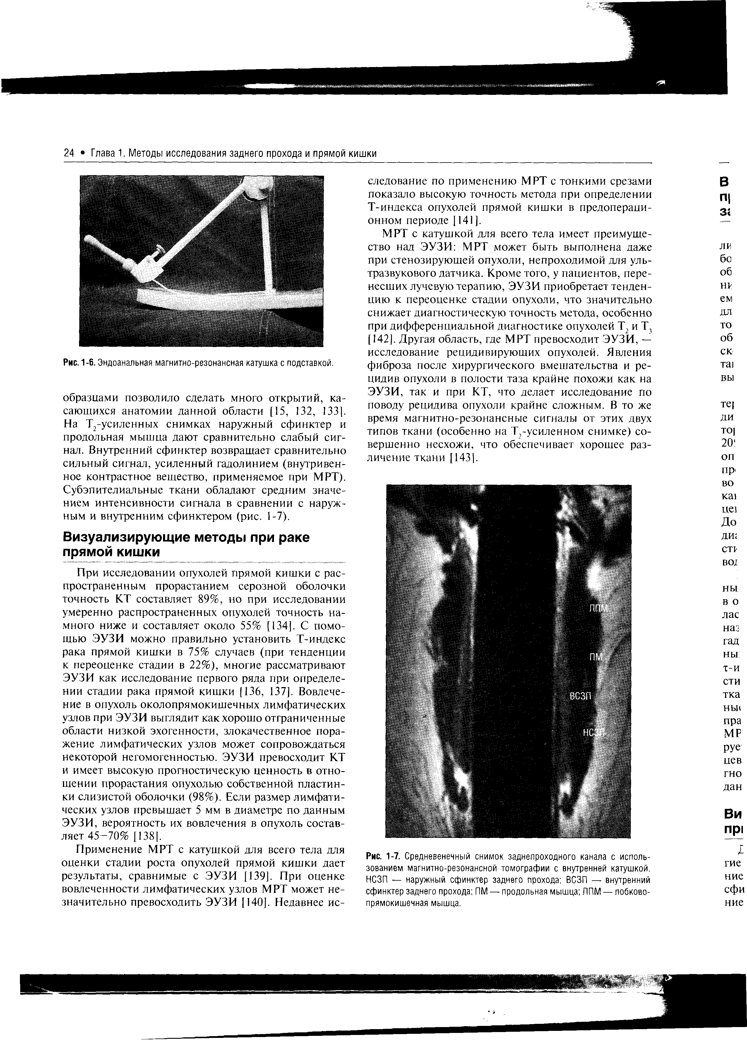 Рис. 1-7. Средневенечный снимок заднепроходного канала с использованием магнитно-резонансной томографии с внутренней катушкой. НСЗП — наружный сфинктер заднего прохода ВСЗП — внутренний сфинктер заднего прохода ПМ — продольная мышца ЛПМ — лобковопрямокишечная мышца.