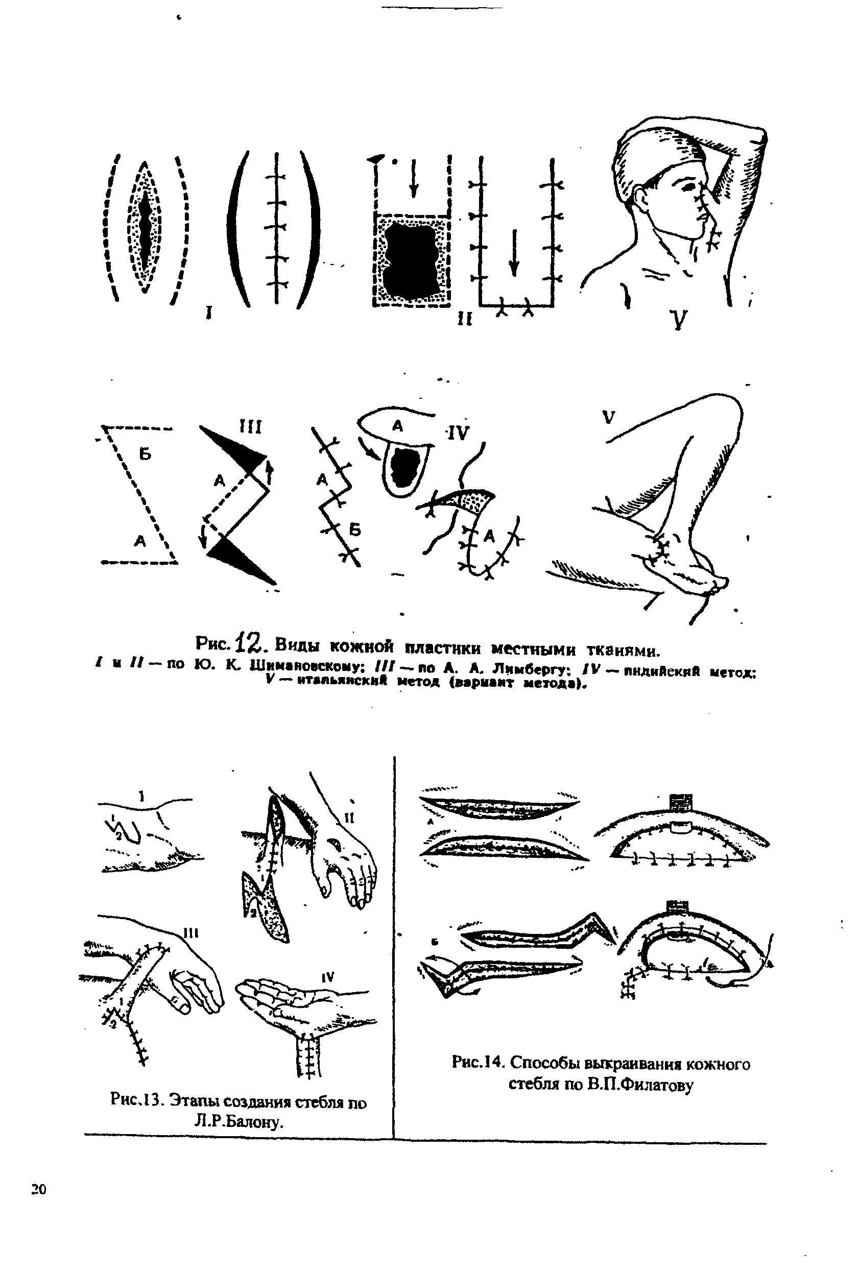 Рис. 12. Виды кожной пластики местными тканями. / //-ПОЮ. К. Шимановскому ///-по А. А. Лимберту /V - пидиЯекиЯ метод ...