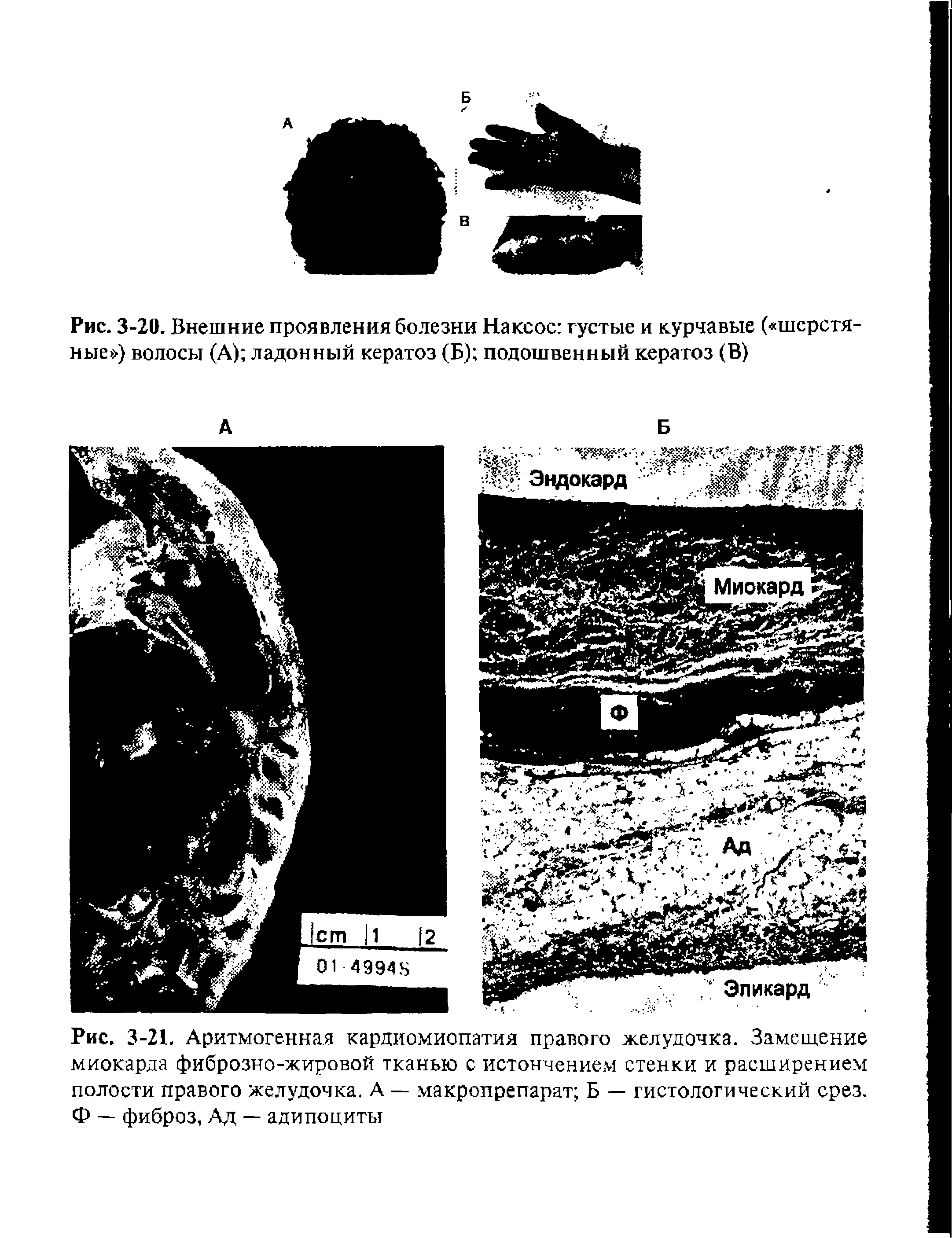 Рис. 3-21. Аритмогенная кардиомиопатия правого желудочка. Замещение миокарда фиброзно-жировой тканью с истончением стенки и расширением полости правого желудочка. А — макропрепарат Б — гистологический срез. Ф — фиброз, Ад — адипоциты...