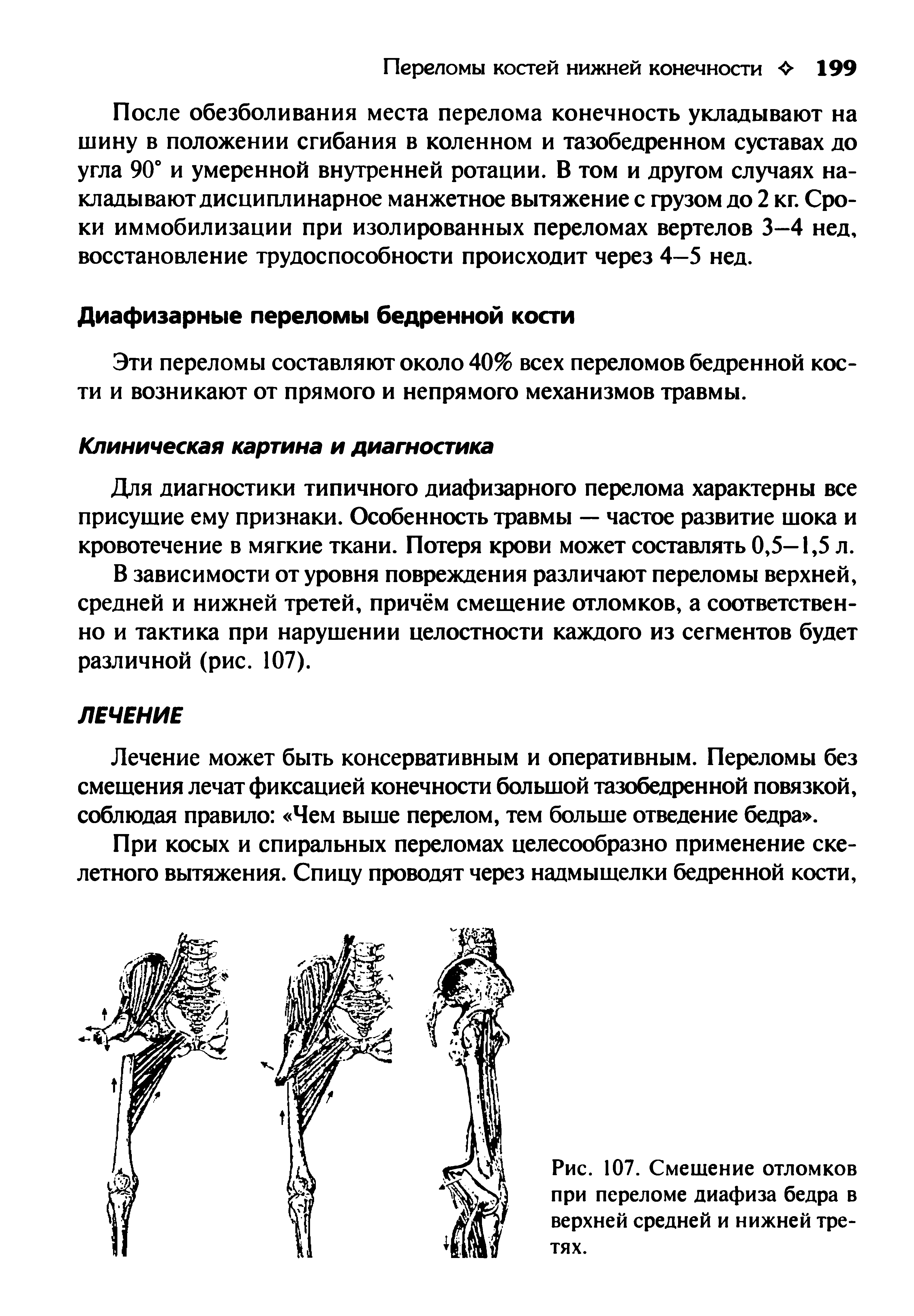 Рис. 107. Смешение отломков при переломе диафиза бедра в верхней средней и нижней третях.