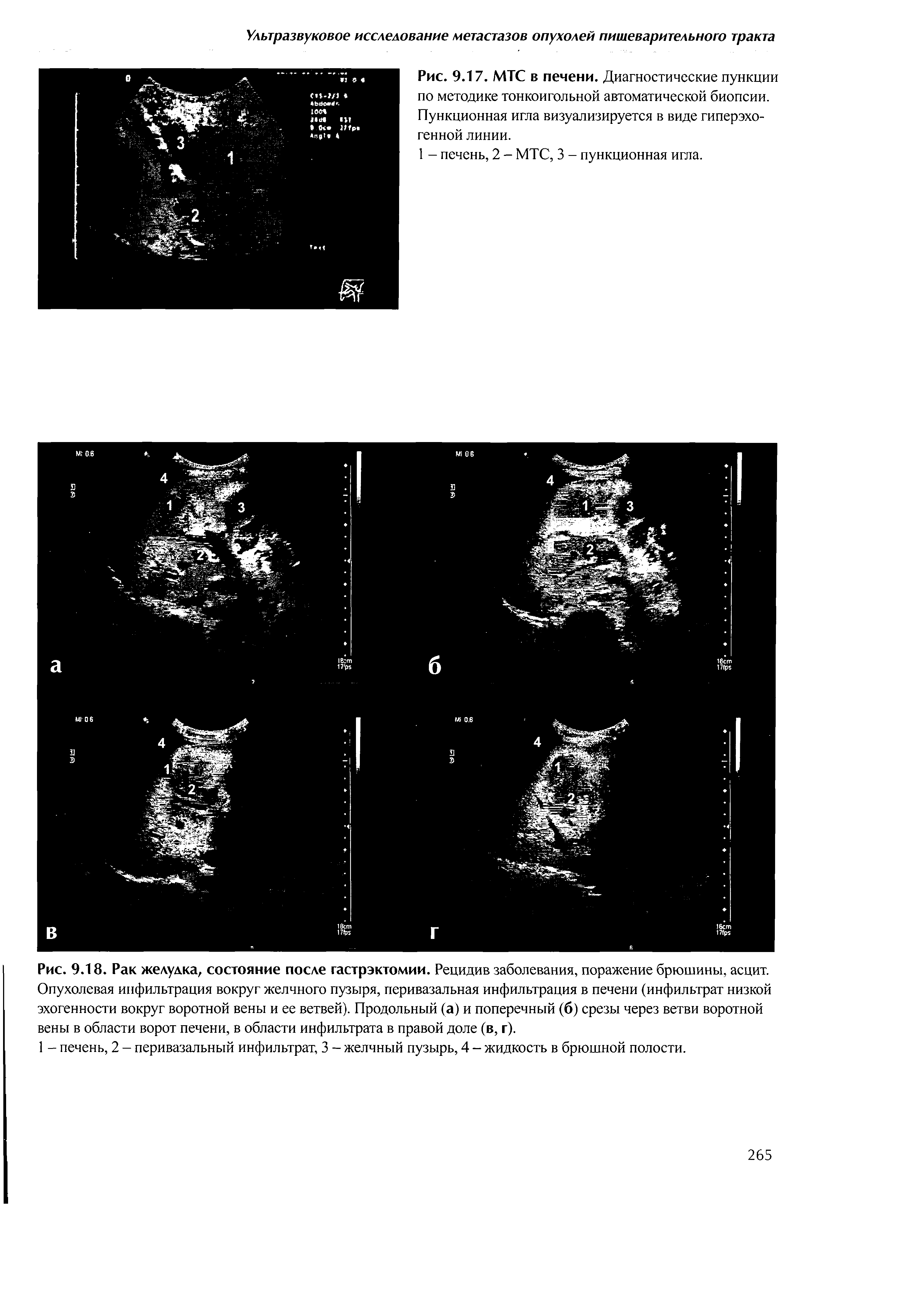 Рис. 9.18. Рак желудка, состояние после гастрэктомии. Рецидив заболевания, поражение брюшины, асцит. Опухолевая инфильтрация вокруг желчного пузыря, перивазальная инфильтрация в печени (инфильтрат низкой эхогенности вокруг воротной вены и ее ветвей). Продольный (а) и поперечный (б) срезы через ветви воротной вены в области ворот печени, в области инфильтрата в правой доле (в, г).
