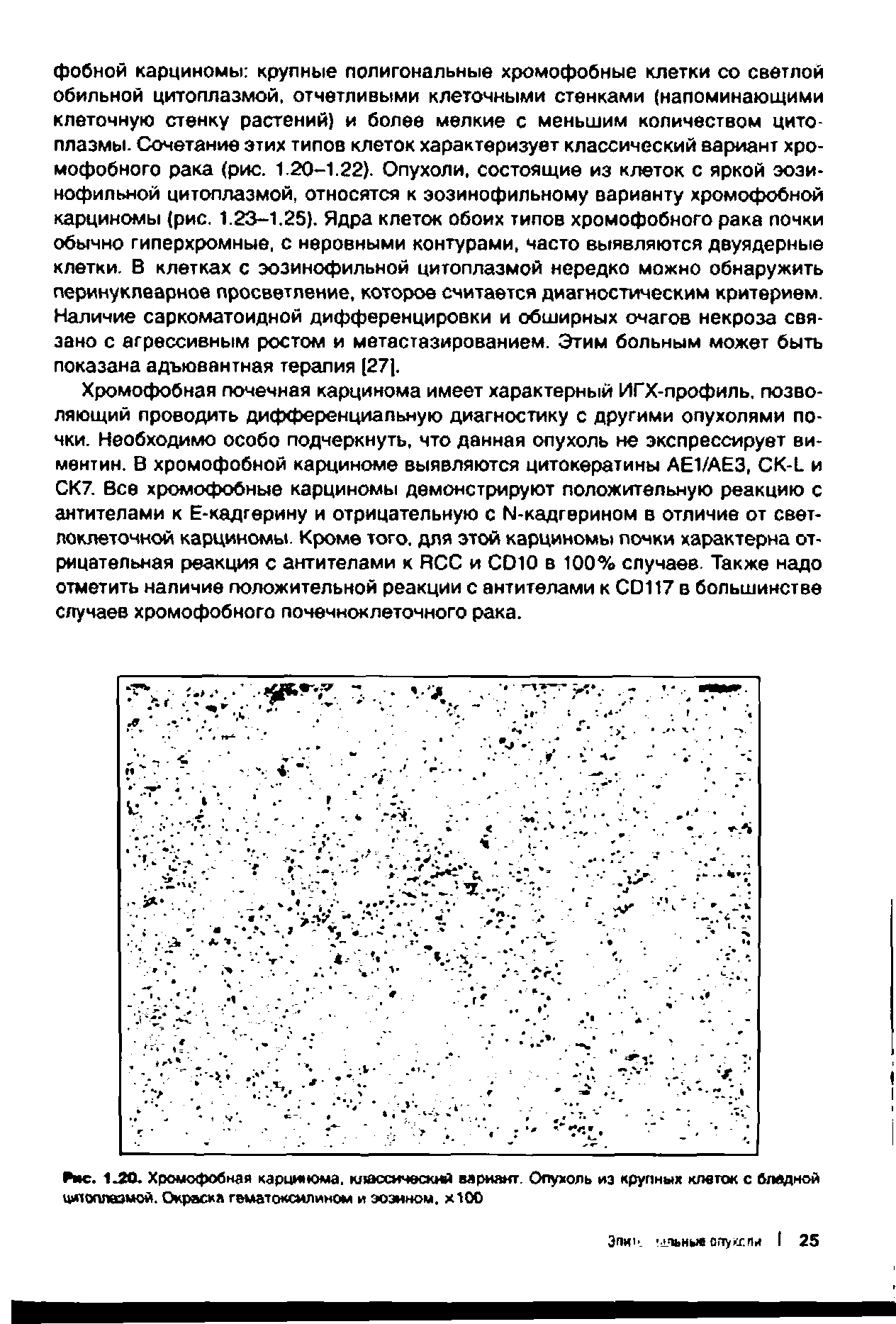 Рис. 1.20. Хромофобная карцинома. классический вариант. Опухоль из крупных клеток с бледной цитоплазмой. Окраска гематоксилином и эозином. х100...