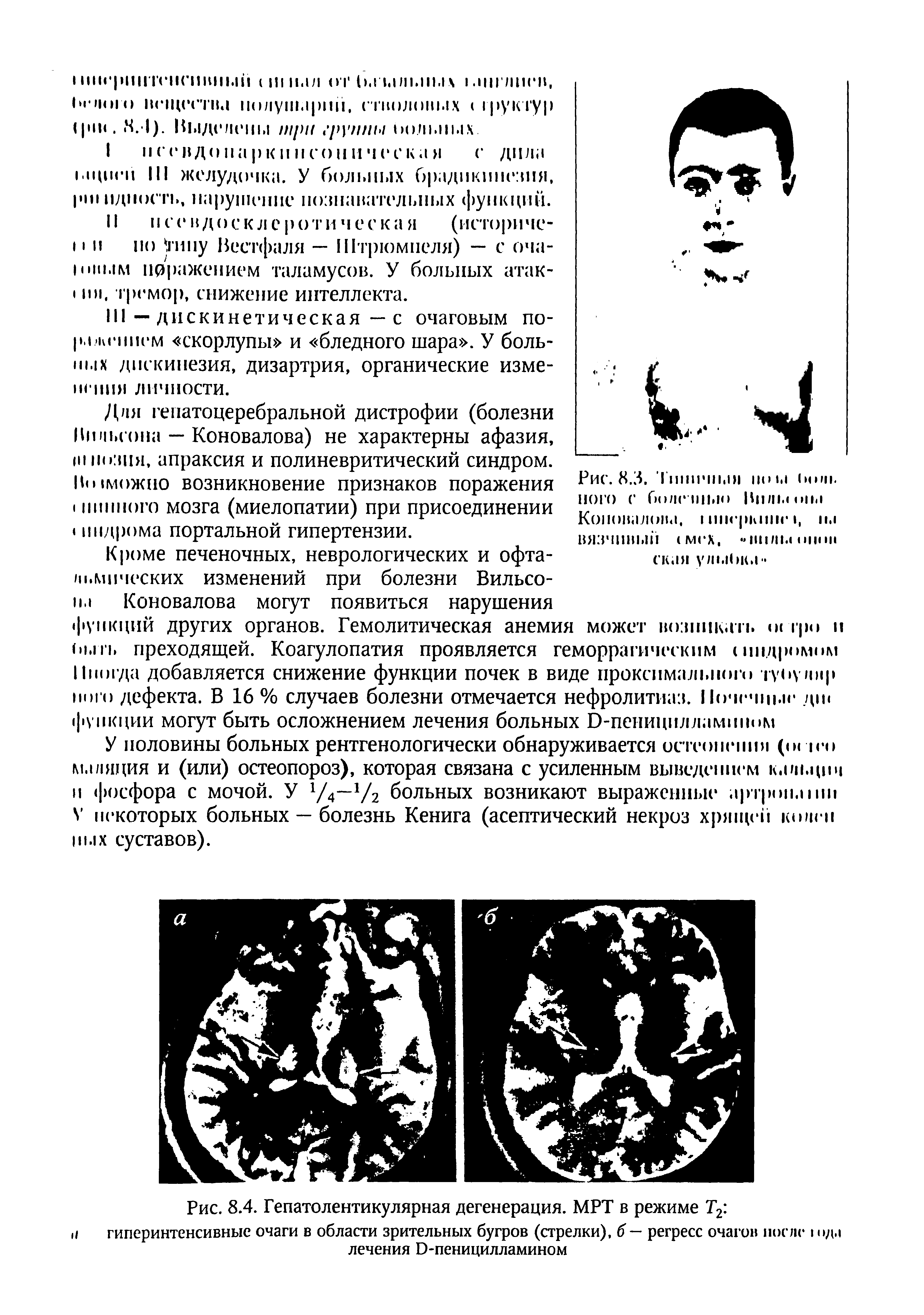 Рис. 8.4. Гепатолентикулярная дегенерация. МРТ в режиме Т2 гиперинтенсивные очаги в области зрительных бугров (стрелки), б — регресс очагов после м>д. лечения D-пеницилламином...