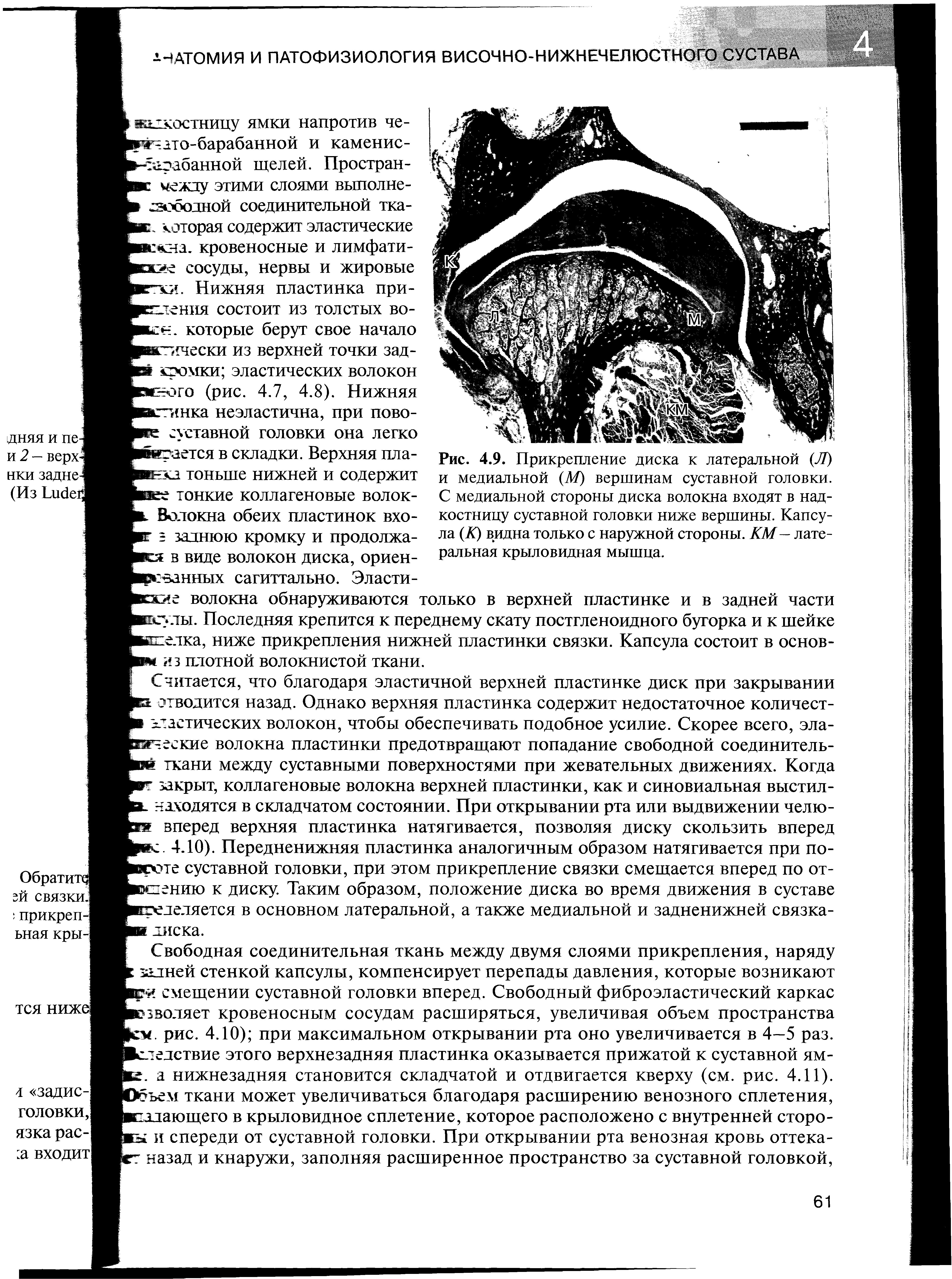 Рис. 4.9. Прикрепление диска к латеральной (77) и медиальной (Л7) вершинам суставной головки. С медиальной стороны диска волокна входят в надкостницу суставной головки ниже вершины. Капсула (К) видна только с наружной стороны. КМ— латеральная крыловидная мышца.