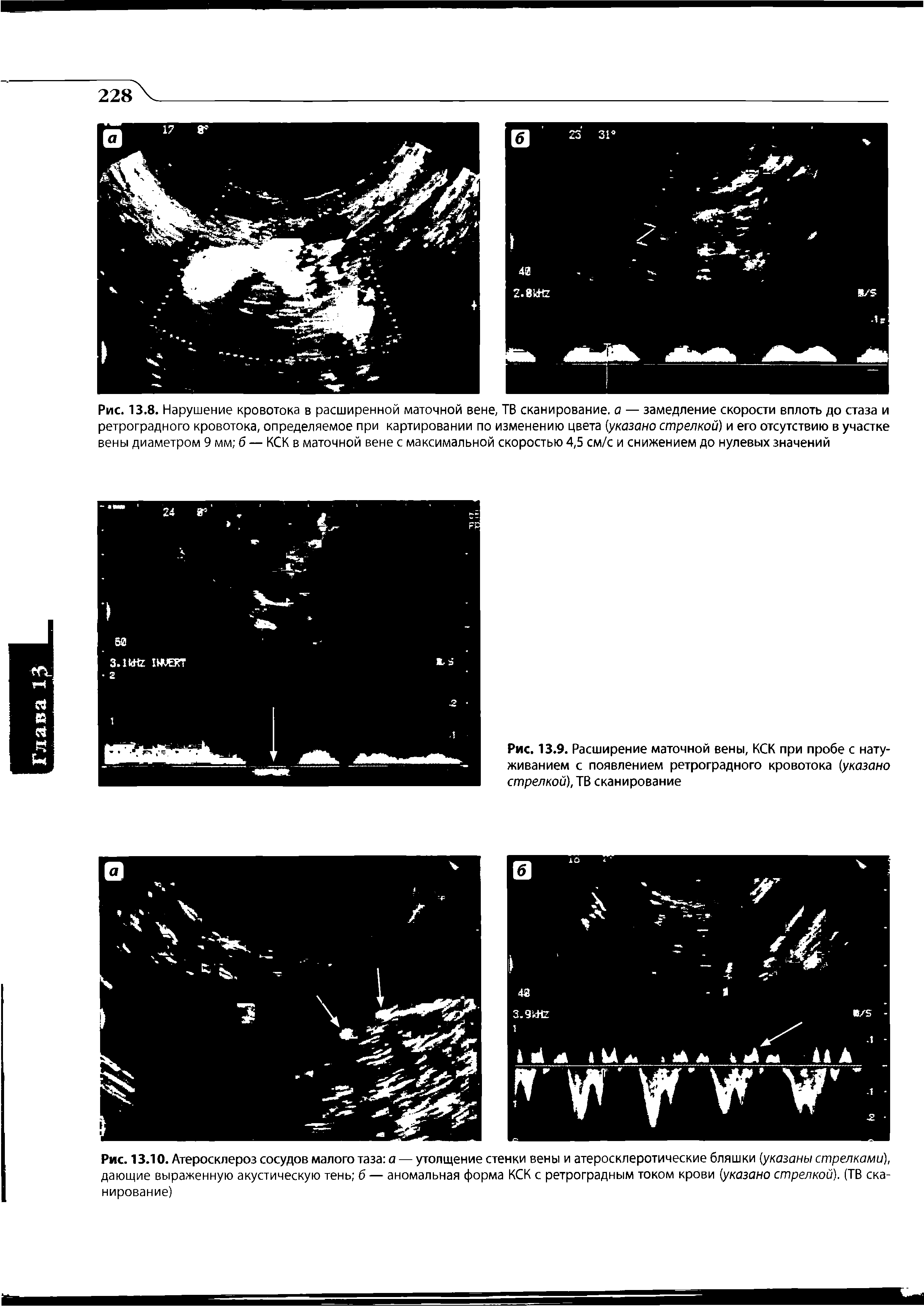 Рис. 13.10. Атеросклероз сосудов малого таза а — утолщение стенки вены и атеросклеротические бляшки (указаны стрелками), дающие выраженную акустическую тень б — аномальная форма КСК с ретроградным током крови (указано стрелкой). (ТВ сканирование)...