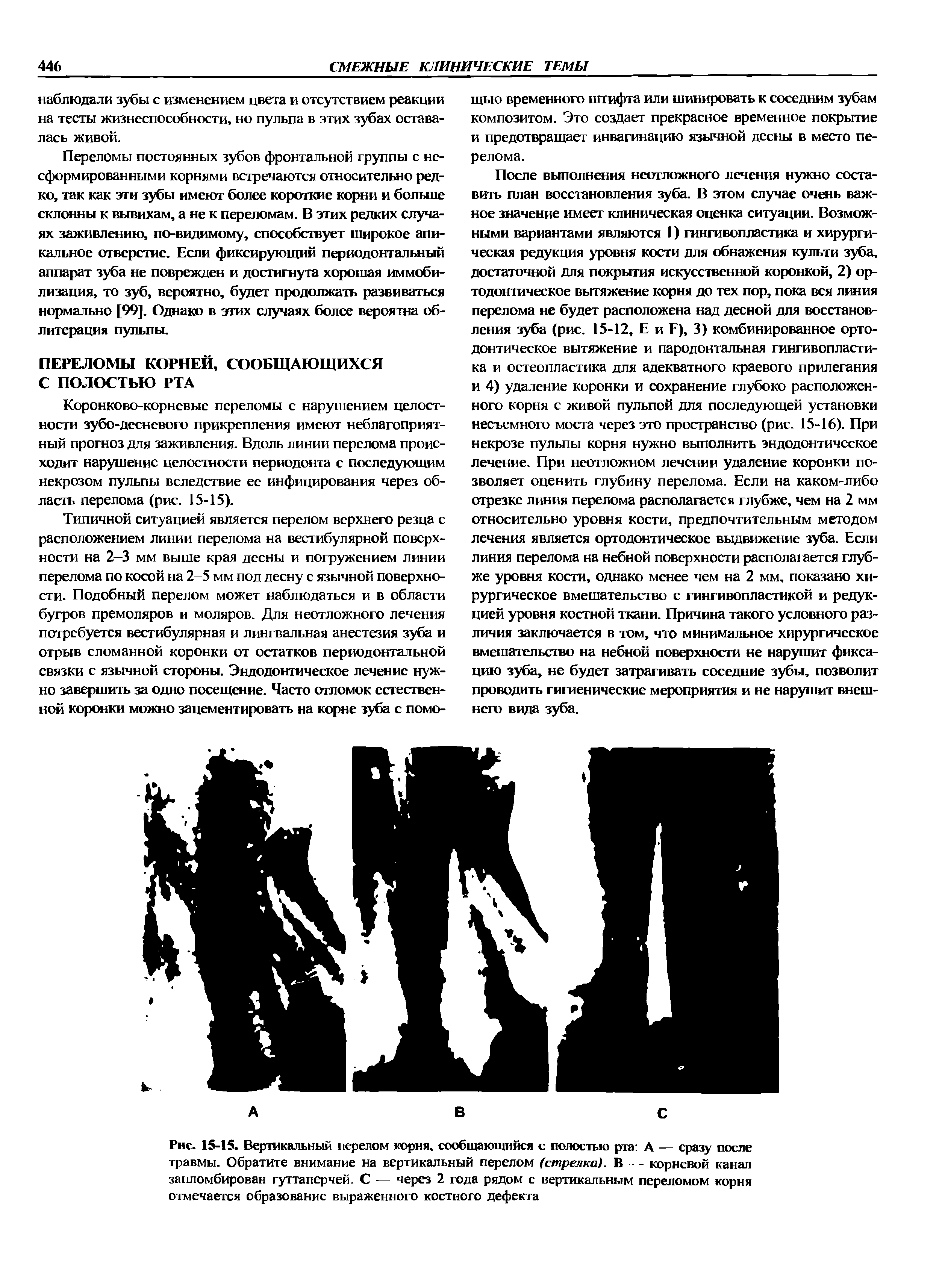 Рис. 15-15. Вертикальный перелом корня, сообщающийся с полостью рта А — сразу после травмы. Обратите внимание на вертикальный перелом (стрелка). В - - корневой канал запломбирован гуттаперчей. С — через 2 года рядом с вертикальным переломом корня отмечается образование выраженного костного дефекта...