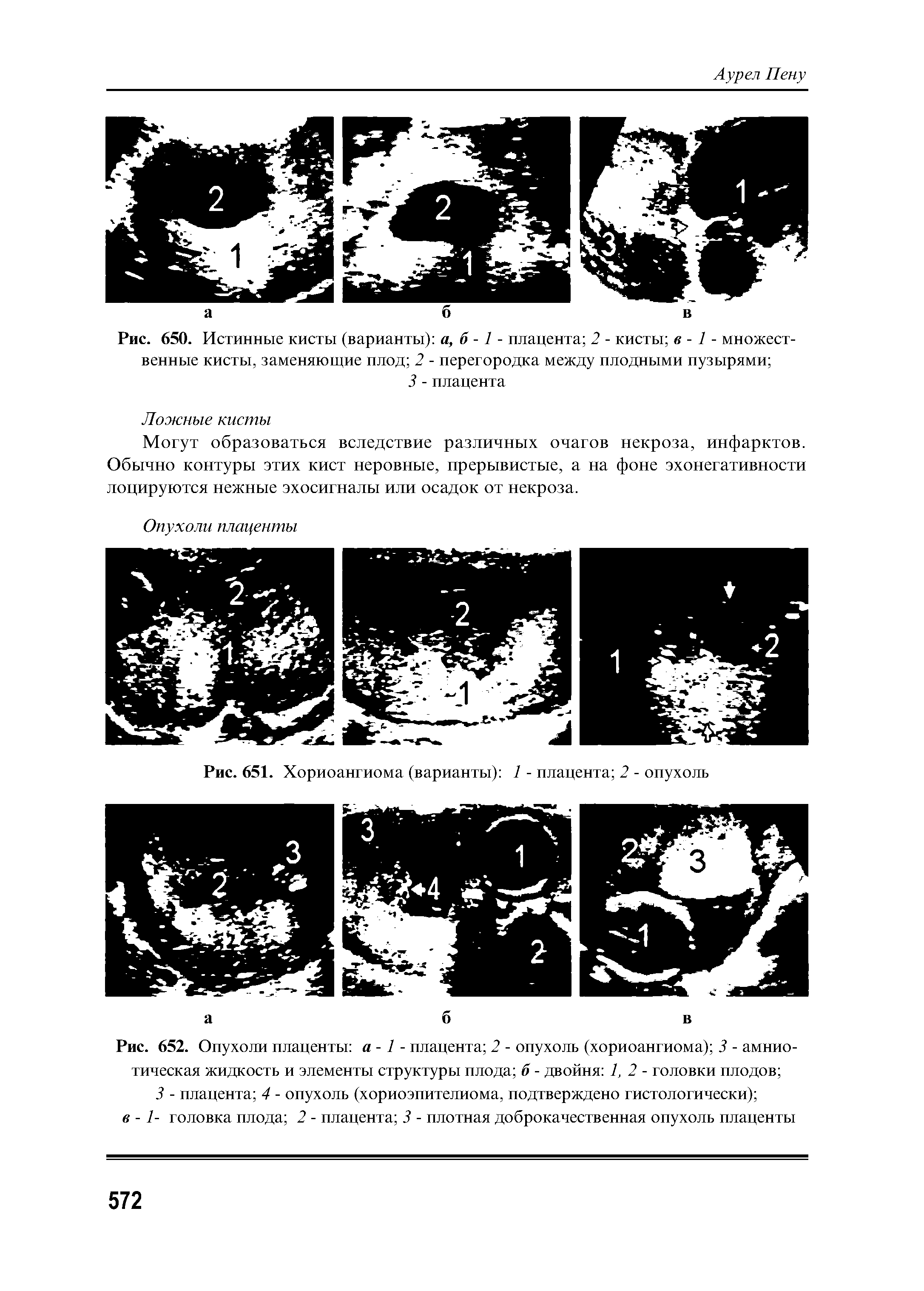 Рис. 652. Опухоли плаценты а -1 - плацента 2 - опухоль (хориоангиома) 3 - амниотическая жидкость и элементы структуры плода б - двойня 1, 2 - головки плодов ...