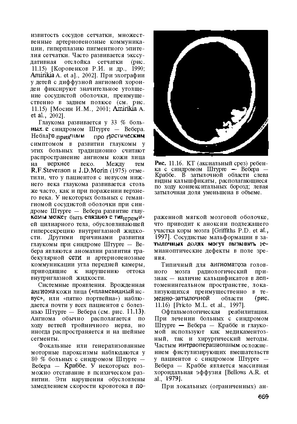 Рис. 11.16. КТ (аксиальный срез) ребенка с синдромом Штурге — Вебера — Краббе. В затылочной области слева видны калышфикаты, располагающиеся по ходу конвекситальных борозд левая затылочная доля уменьшена в объеме.