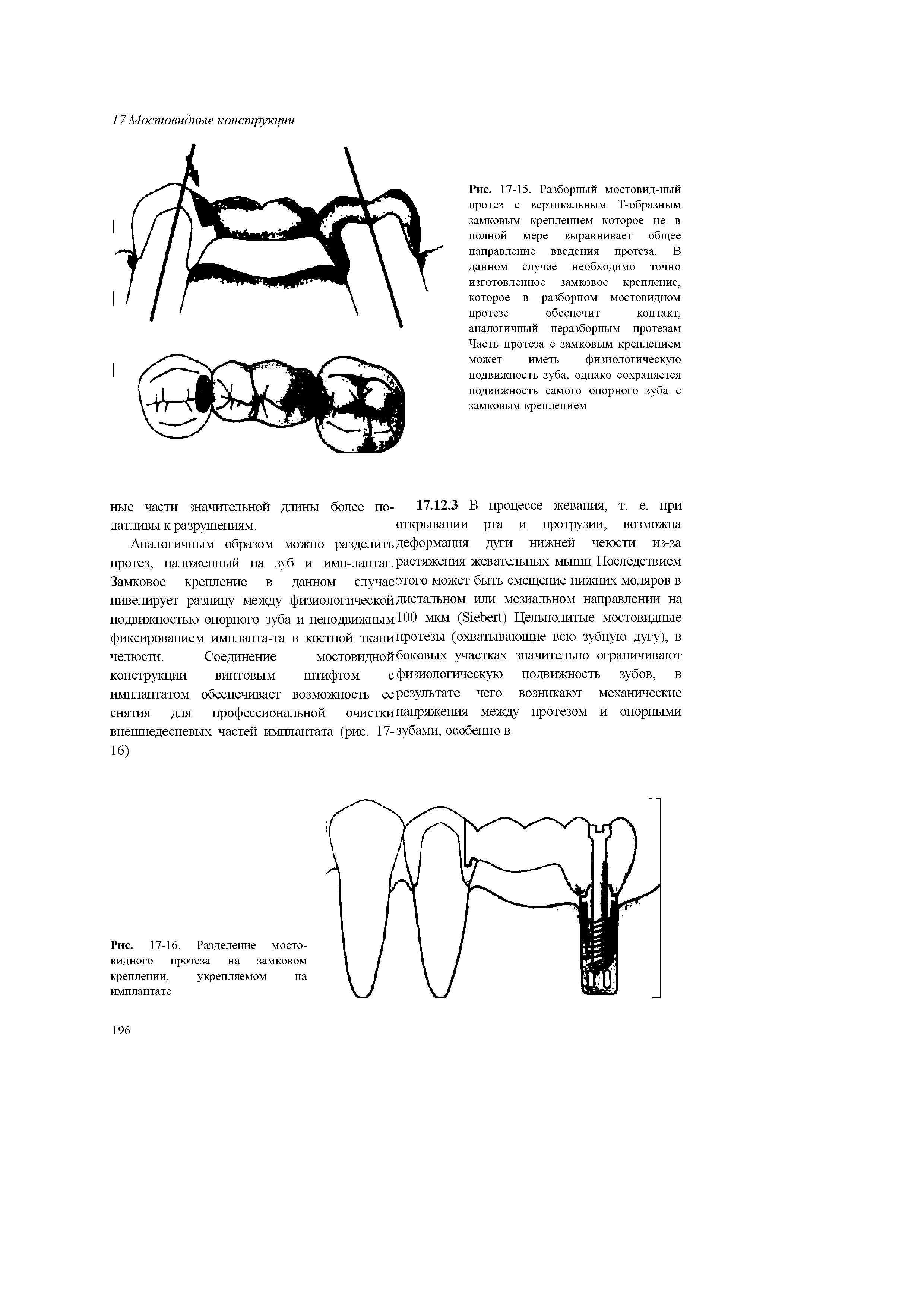 Рис. 17-15. Разборный мостовид-ный протез с вертикальным Т-образным замковым креплением которое не в полной мере выравнивает общее направление введения протеза. В данном случае необходимо точно изготовленное замковое крепление, которое в разборном мостовидном протезе обеспечит контакт,...