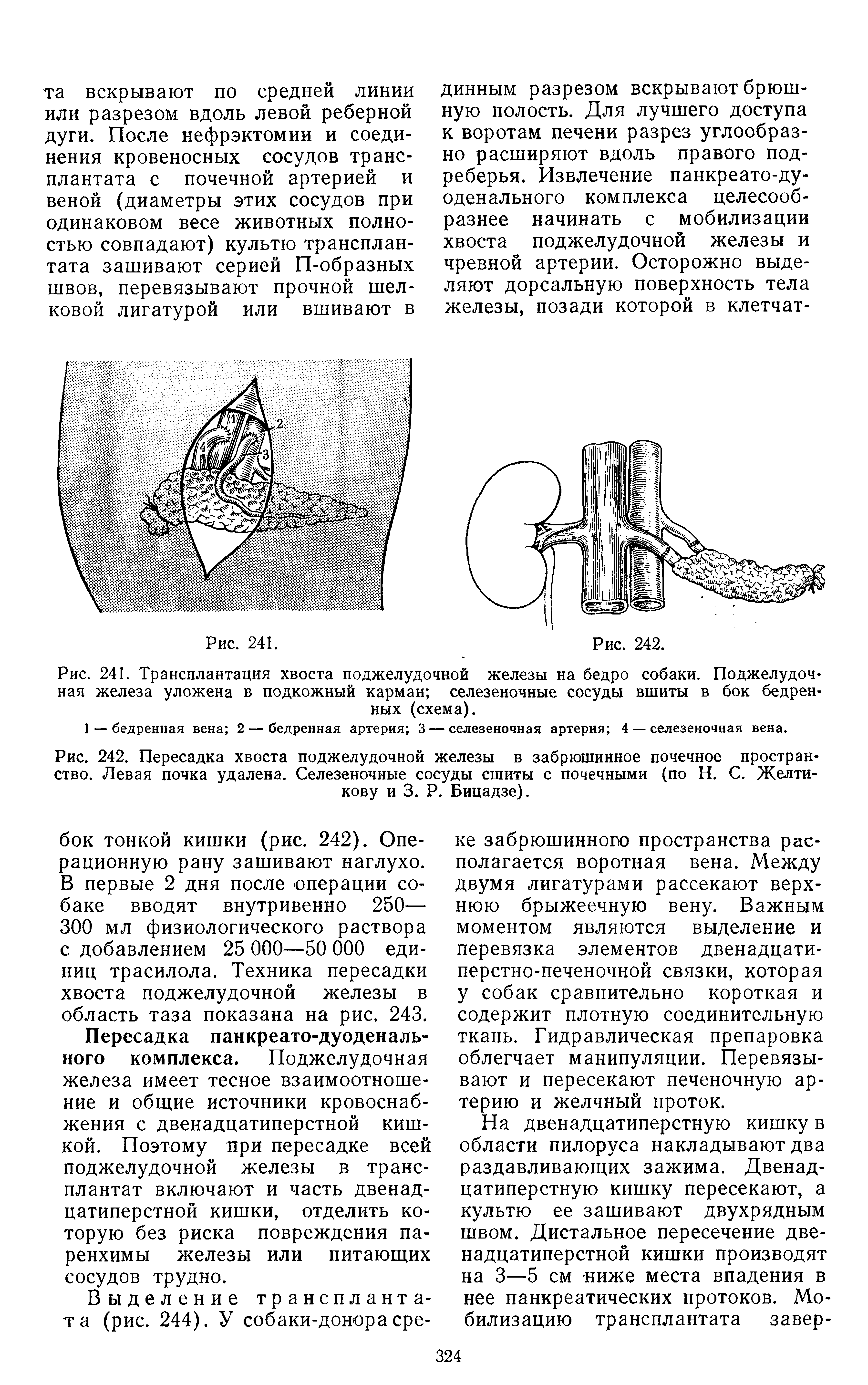 Рис. 242. Пересадка хвоста поджелудочной железы в забрюшинное почечное пространство. Левая почка удалена. Селезеночные сосуды сшиты с почечными (по Н. С. Желти-кову и 3. Р. Бицадзе).