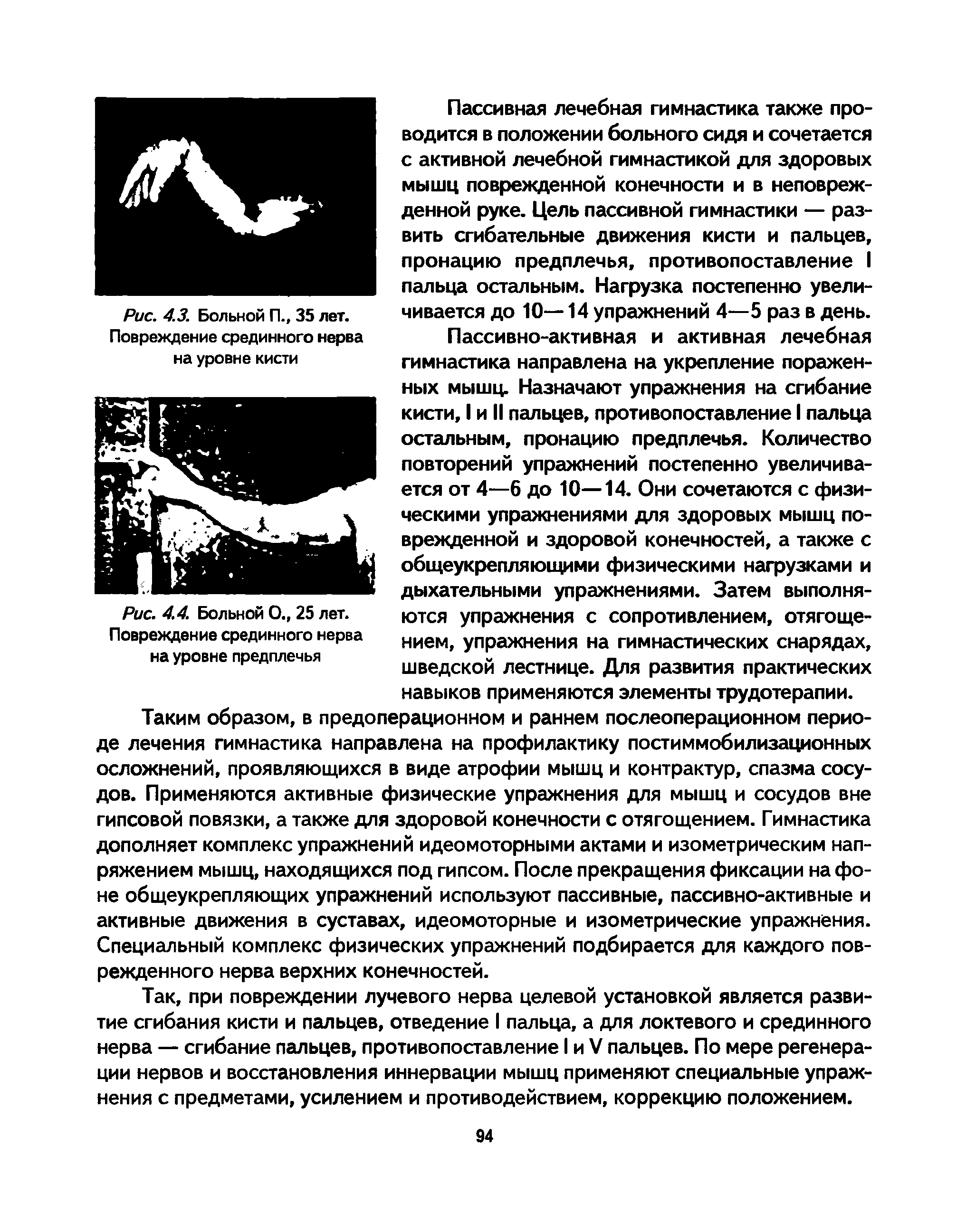 Рис. 4.4. Больной О., 25 лет. Повреждение срединного нерва на уровне предплечья...