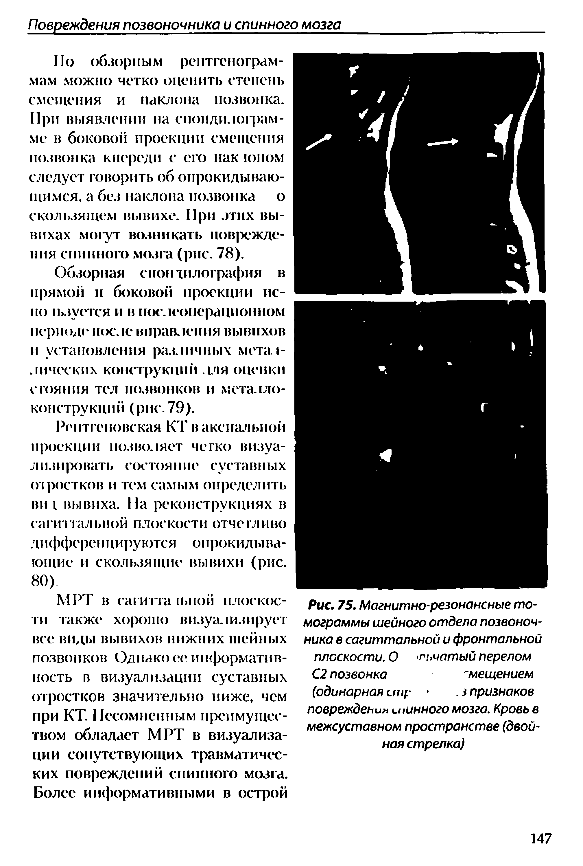 Рис. 75. Магнитно-резонансные томограммы шейного отдела позвоночника в сагиттальной и фронтальной плоскости. О >пьчатый перелом С2 позвонка смещением...