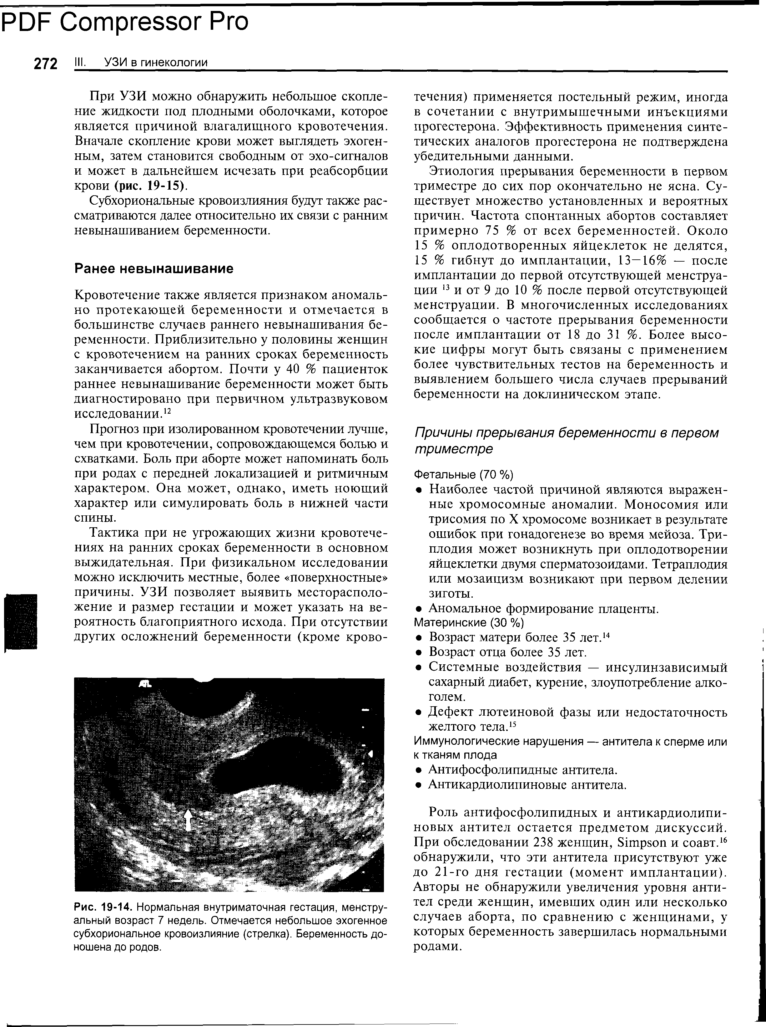 Рис. 19-14. Нормальная внутриматочная гестация, менструальный возраст 7 недель. Отмечается небольшое эхогенное субхориональное кровоизлияние (стрелка). Беременность доношена до родов.