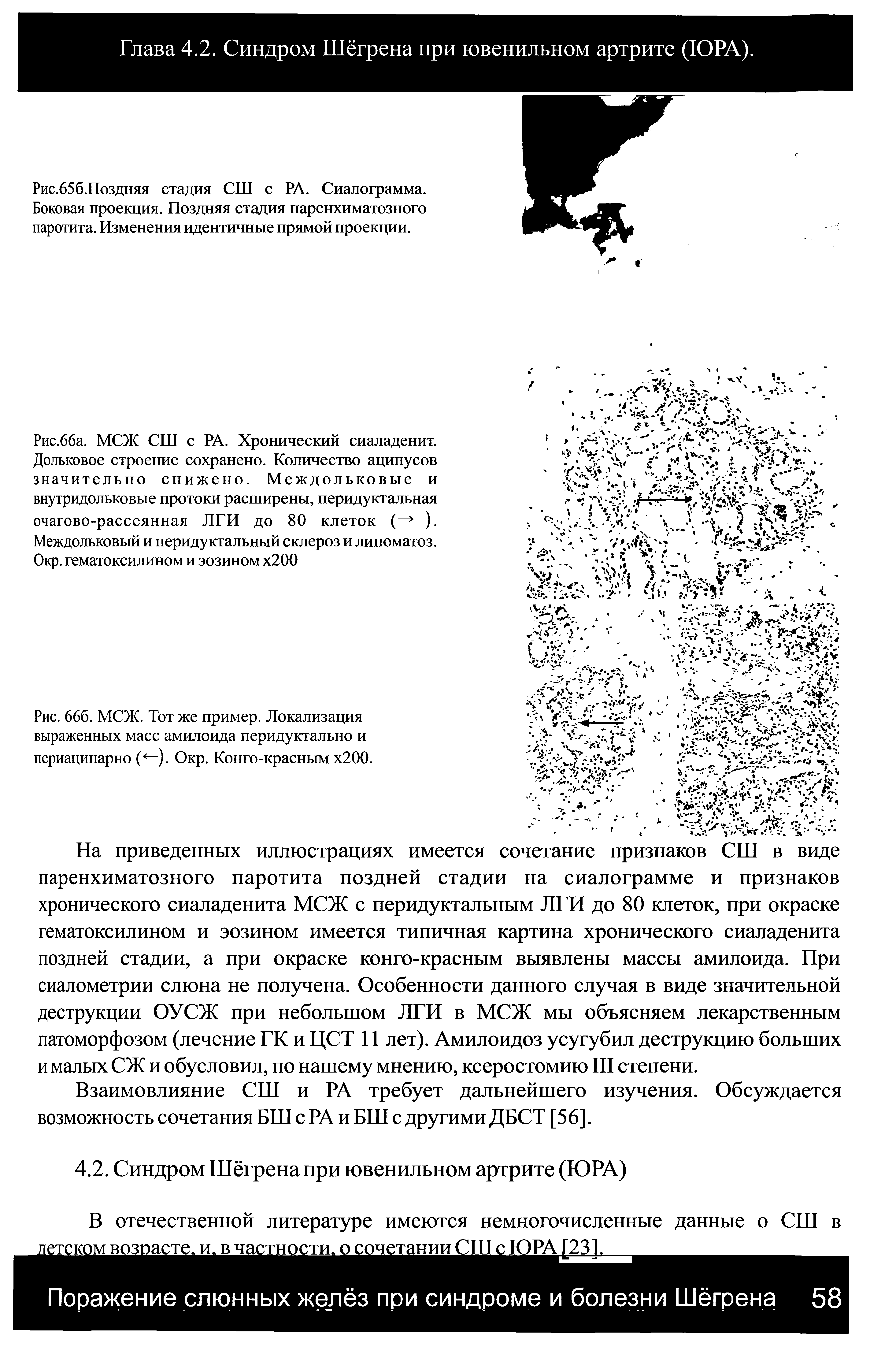 Рис. 666. МСЖ. Тот же пример. Локализация выраженных масс амилоида перидуктально и периацинарно (<—). Окр. Конго-красным х200.