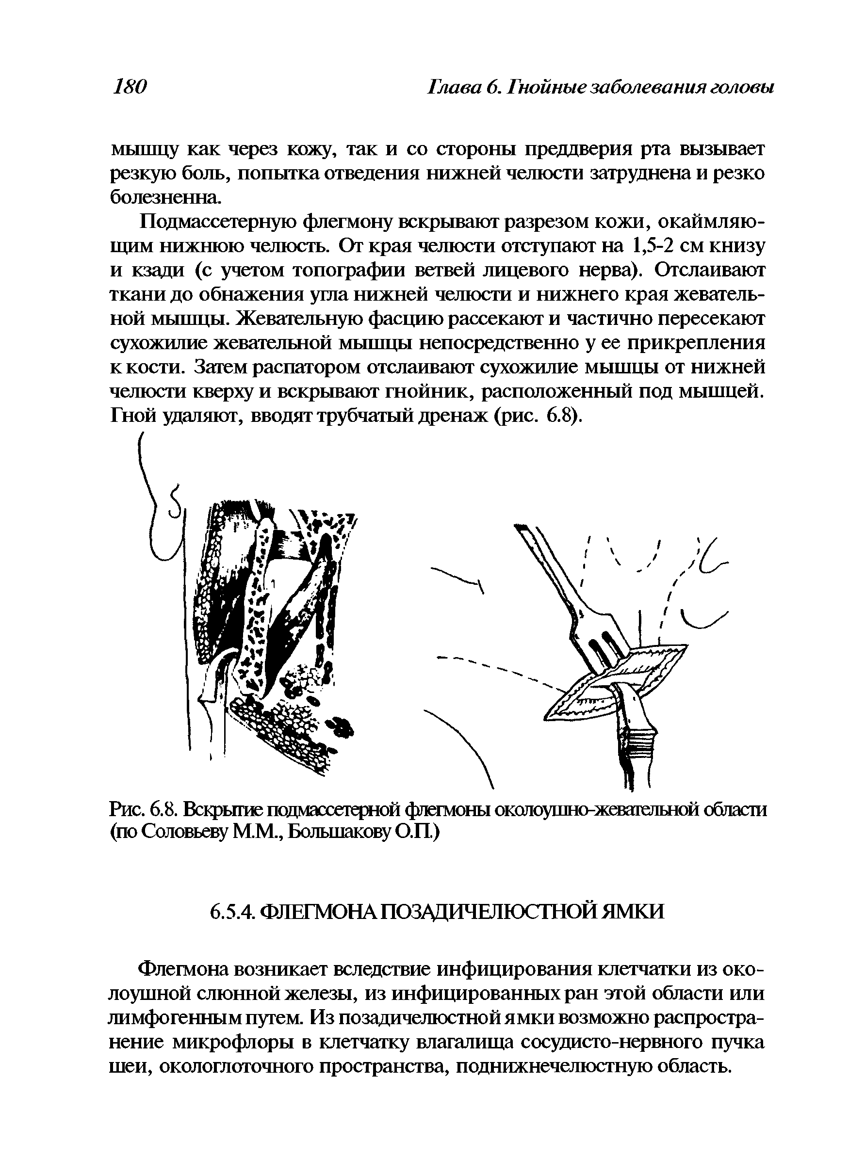 Рис. 6.8. Вскрытие псдмассегерной флегмоны околоушно-жевательной области (по Соловьеву М.М., Большакову О.П.)...