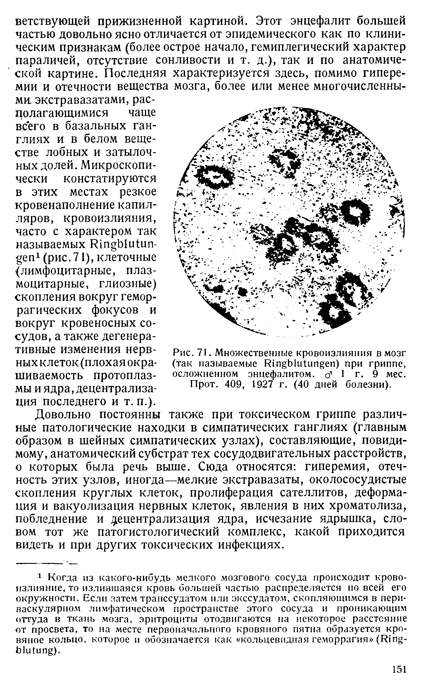 Рис. 71. Множественные кровоизлияния в мозг (так называемые Иг ЫиШг еп) при гриппе, осложненном энцефалитом, о1 1 г. 9 мес.