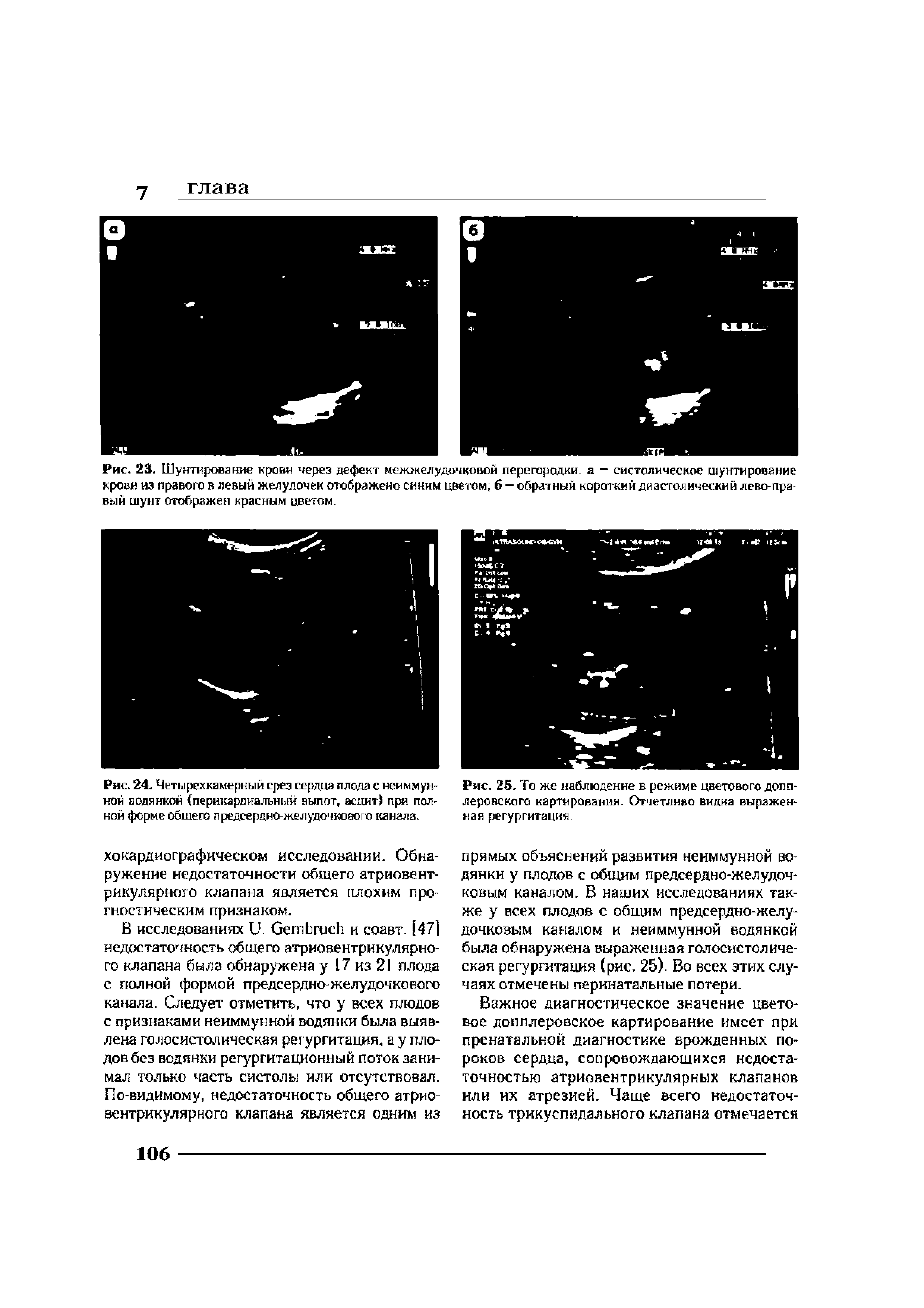 Рис. 24. Четы рек камерный срез сердца плода с неиммун-ной водянкой (перикардиальный выпот, аспит) при полной форме общего предсердно-желудочкового канала.