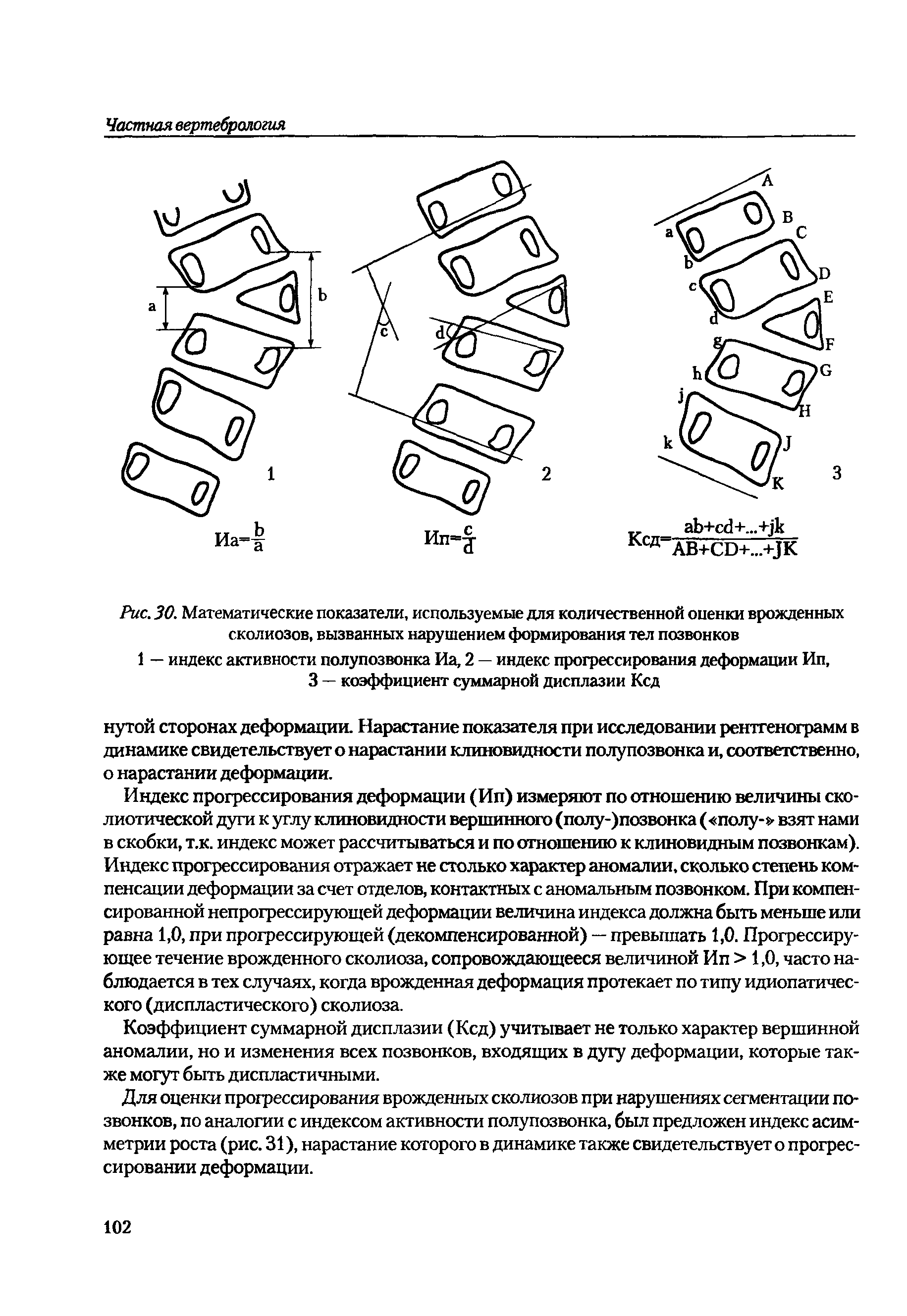 Рис. 30. Математические показатели, используемые д ля количественной опенки врожденных сколиозов, вызванных нарушением формирования тел позвонков...