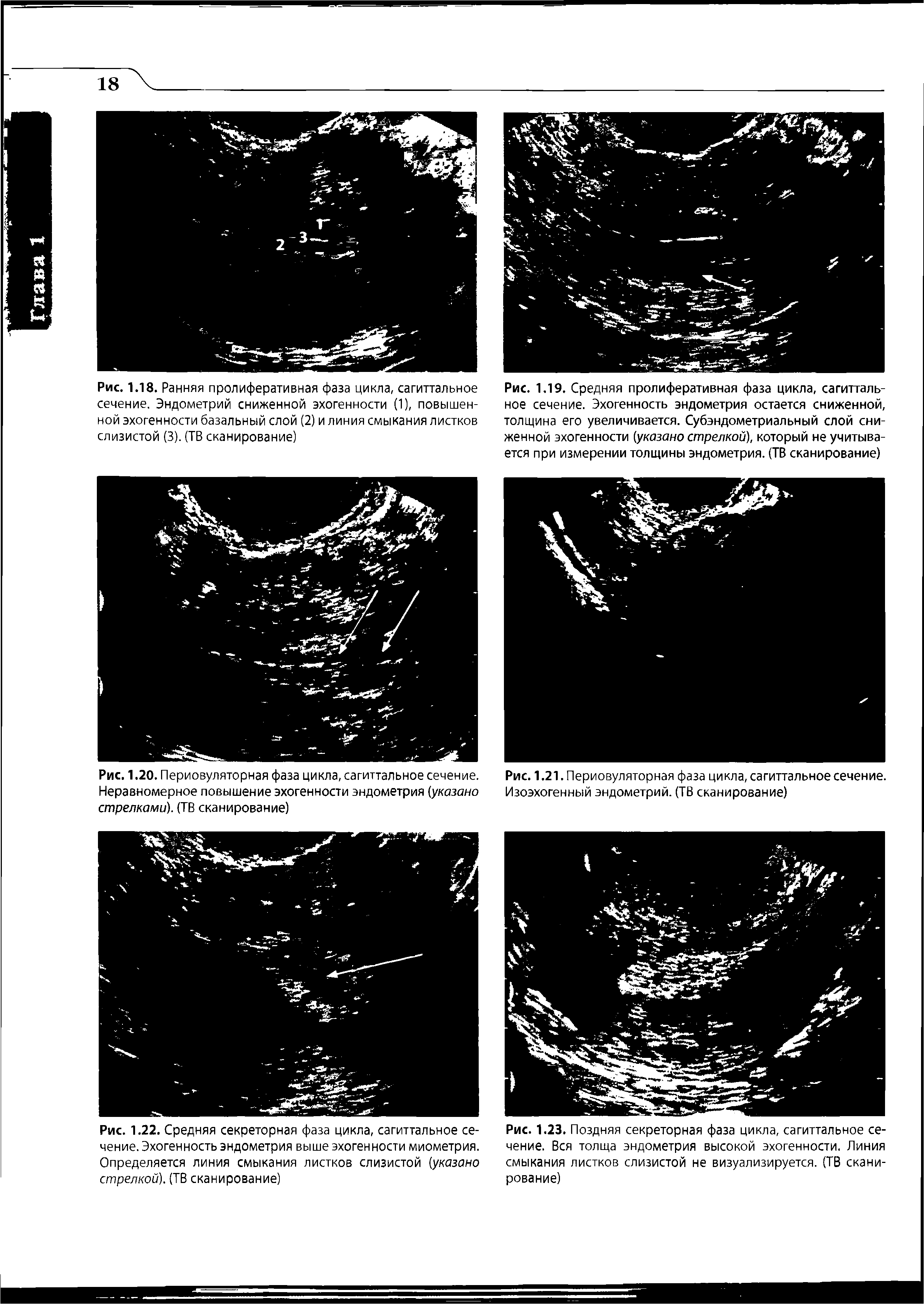 Рис. 1.18. Ранняя пролиферативная фаза цикла, сагиттальное сечение. Эндометрий сниженной эхогенности (1), повышенной эхогенности базальный слой (2) и линия смыкания листков слизистой (3). (ТВ сканирование)...