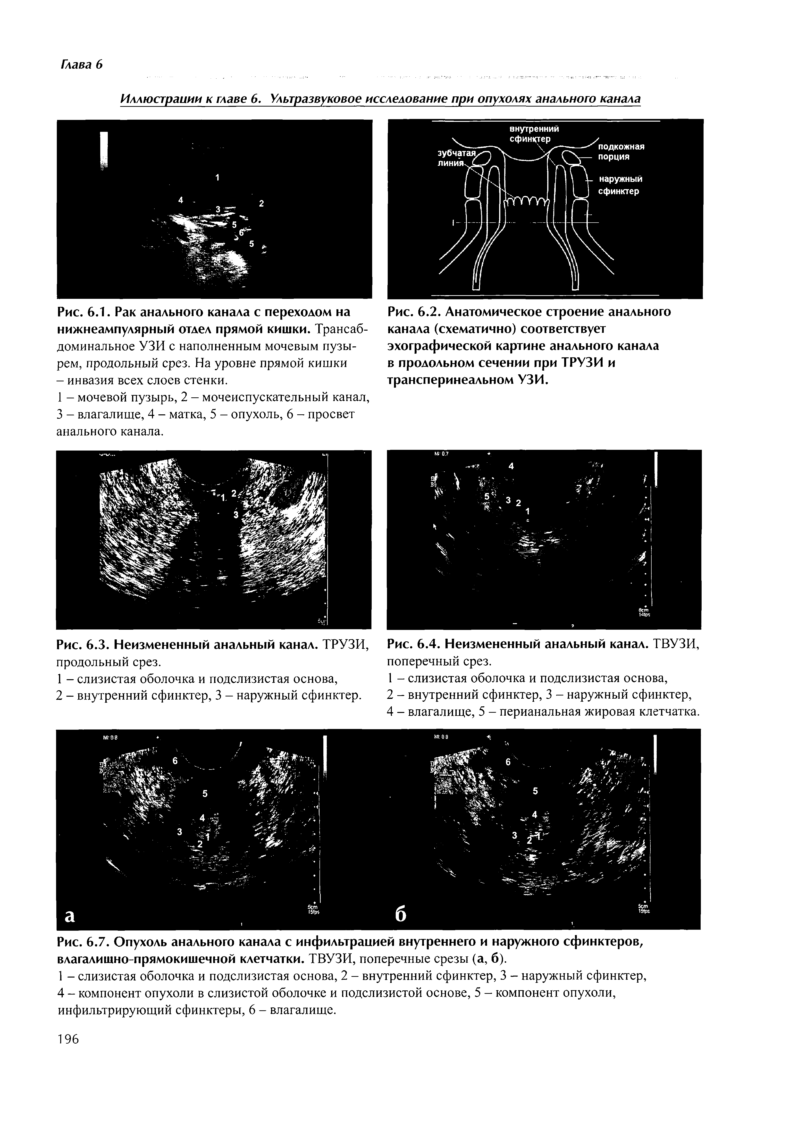 Рис. 6.2. Анатомическое строение анального канала (схематично) соответствует эхографической картине анального канала в продольном сечении при ТРУЗИ и трансперинеальном УЗИ.