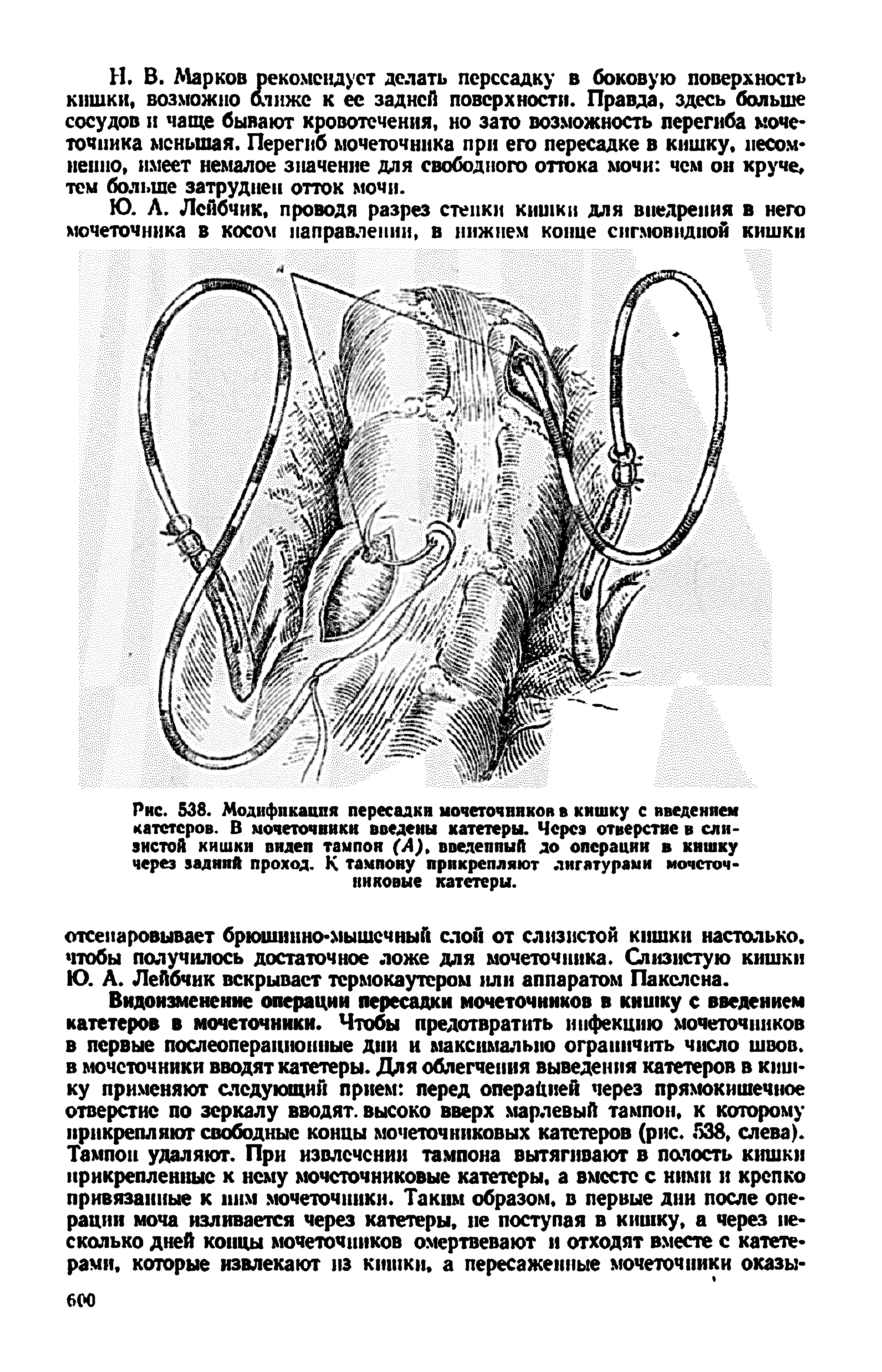Рис. 538. Модификация пересадки мочеточников в кишку с введением катетеров. В мочеточники введены катетеры. Через отверстие в слизистой кишки видел тампон (А), введеппый до операции в кишку через задний проход. К тампону прикрепляют лигатурами мочеточниковые катетеры.