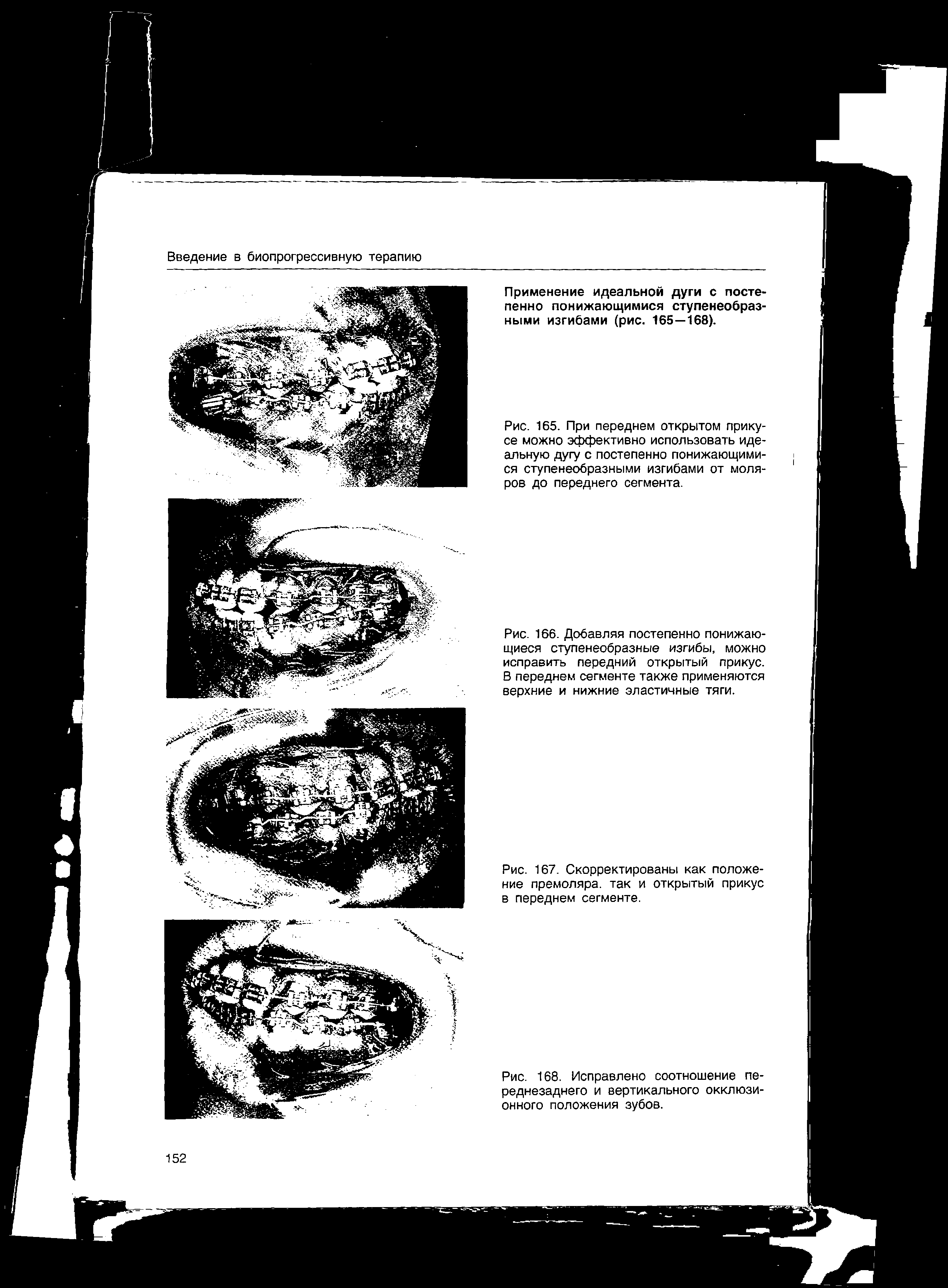 Рис. 165. При переднем открытом прикусе можно эффективно использовать идеальную дугу с постепенно понижающимися ступенеобразными изгибами от моляров до переднего сегмента.