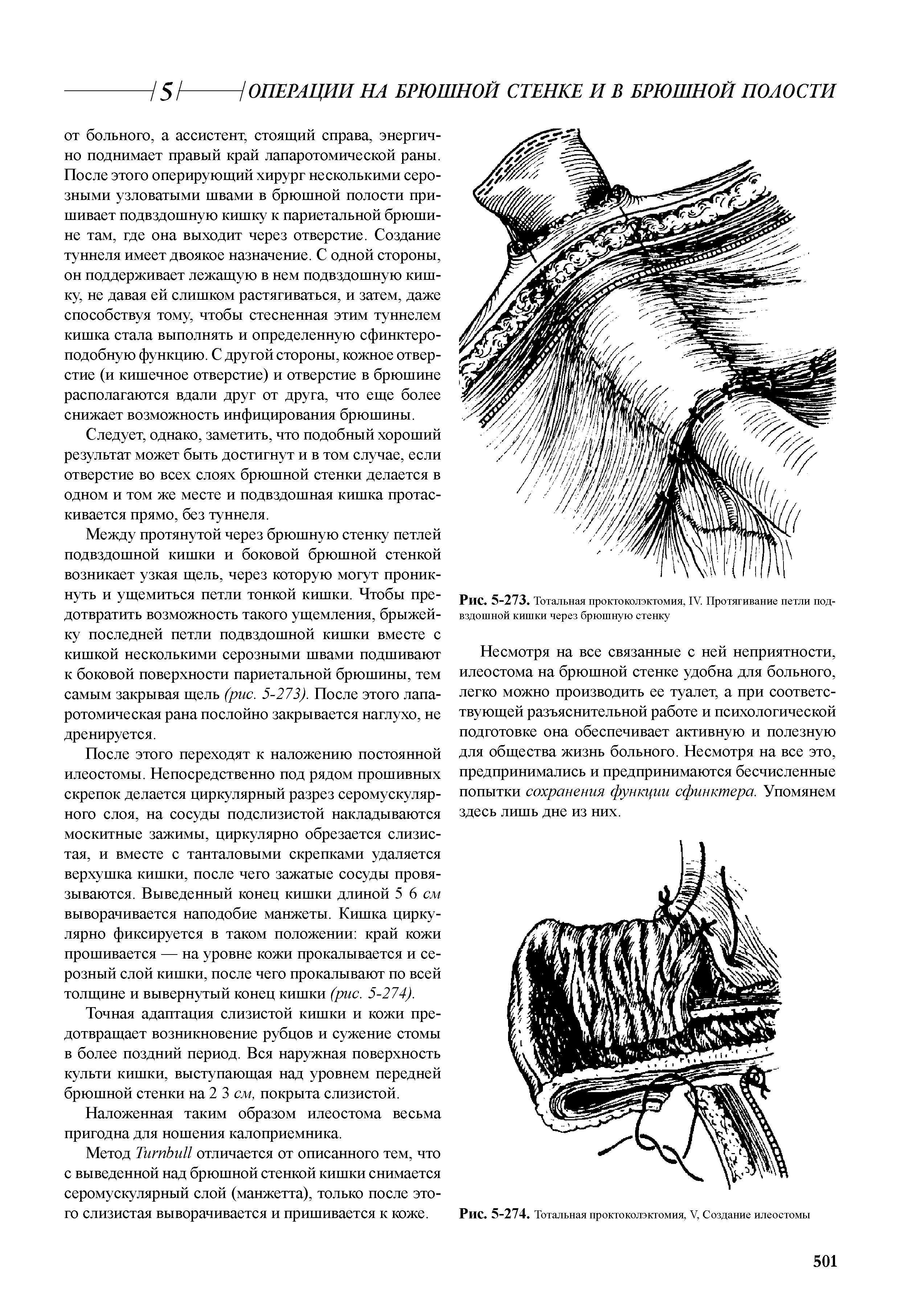 Рис. 5-273. Тотальная проктоколэктомия, IV. Протягивание петли подвздошной кишки через брюшную стенку...