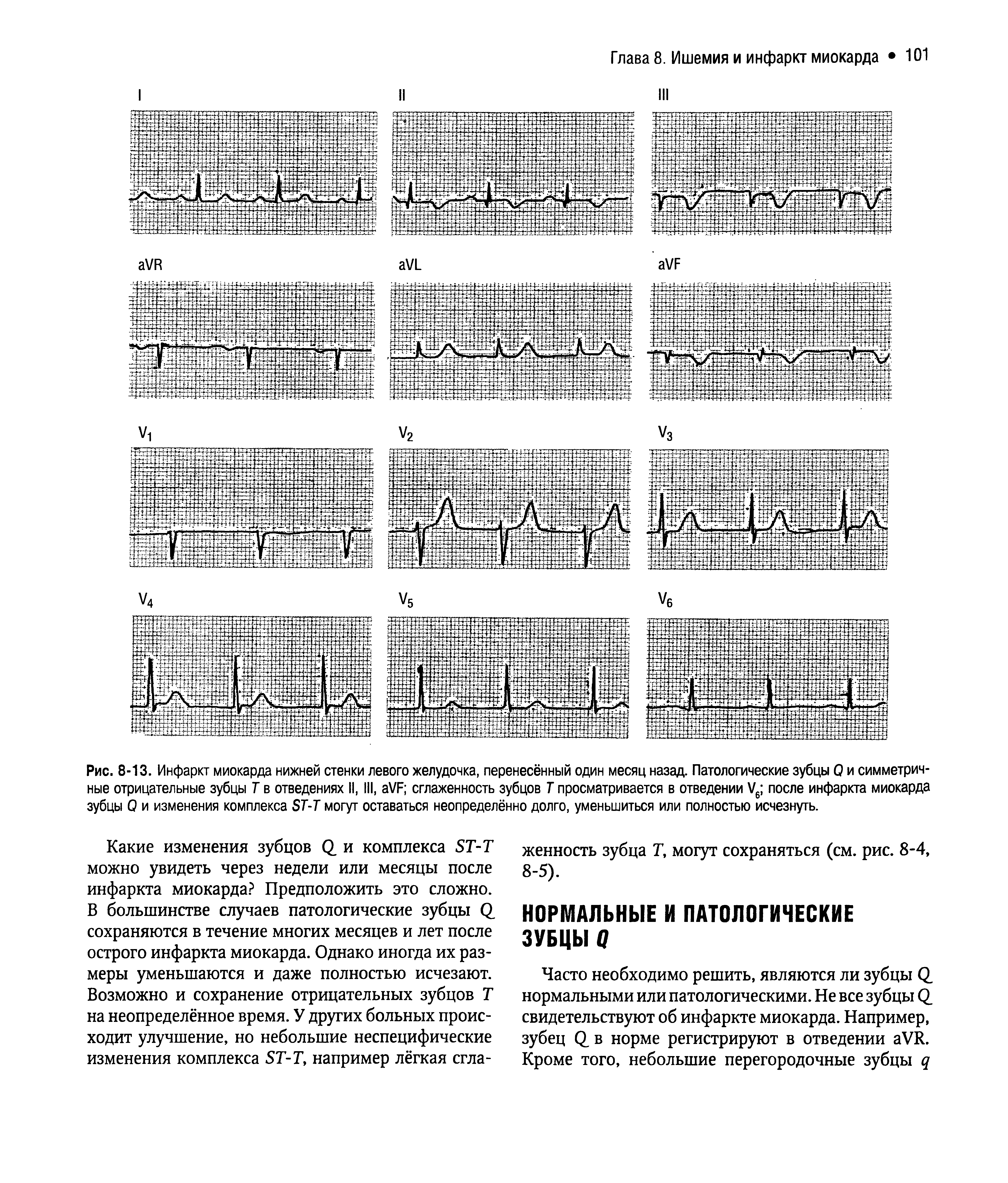 Рис. 8-13. Инфаркт миокарда нижней стенки левого желудочка, перенесённый один месяц назад. Патологические зубцы Q и симметричные отрицательные зубцы Т в отведениях II, III, VF сглаженность зубцов Т просматривается в отведении V6 после инфаркта миокарда зубцы Q и изменения комплекса ST-T могут оставаться неопределённо долго, уменьшиться или полностью исчезнуть.