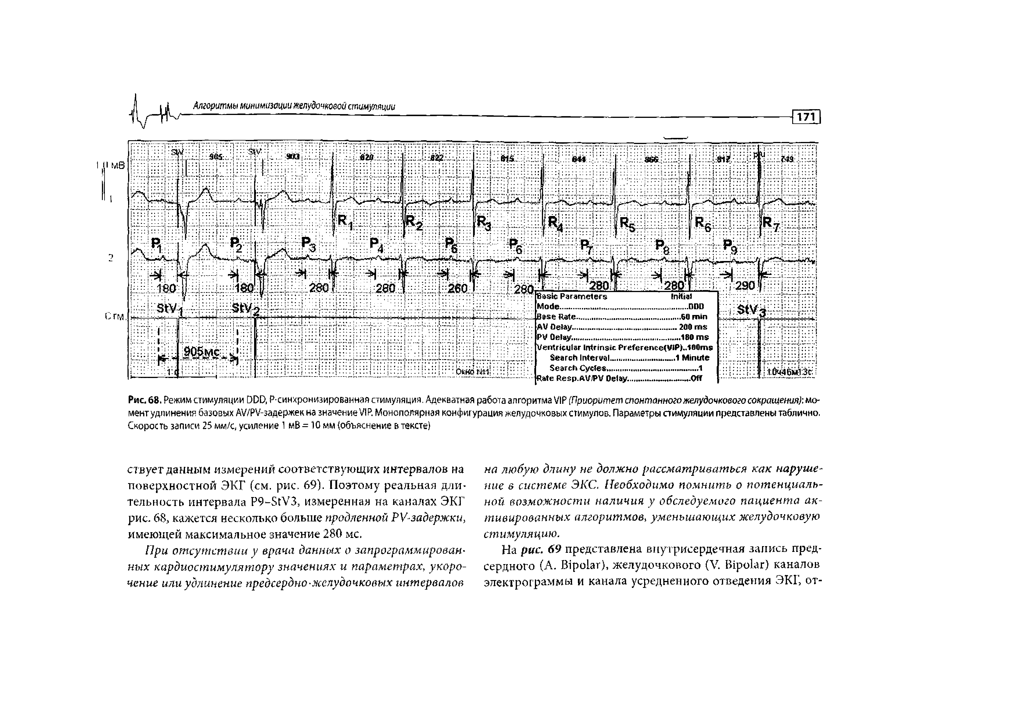 Рис. 68. Режим стимуляции DDD, P-синхронизированная стимуляция. Адекватная работа алгоритма VIP (Приоритет спонтанного желудочкового сокращения) момент удлинения базовых AV/PV-задержек на значение VIР. Монополярная конфигурация желудочковых стимулов. Параметры стимуляции представлены таблично. Скорость записи 25 мм/с, усиление I мВ= Ю мм (объяснение в тексте)...