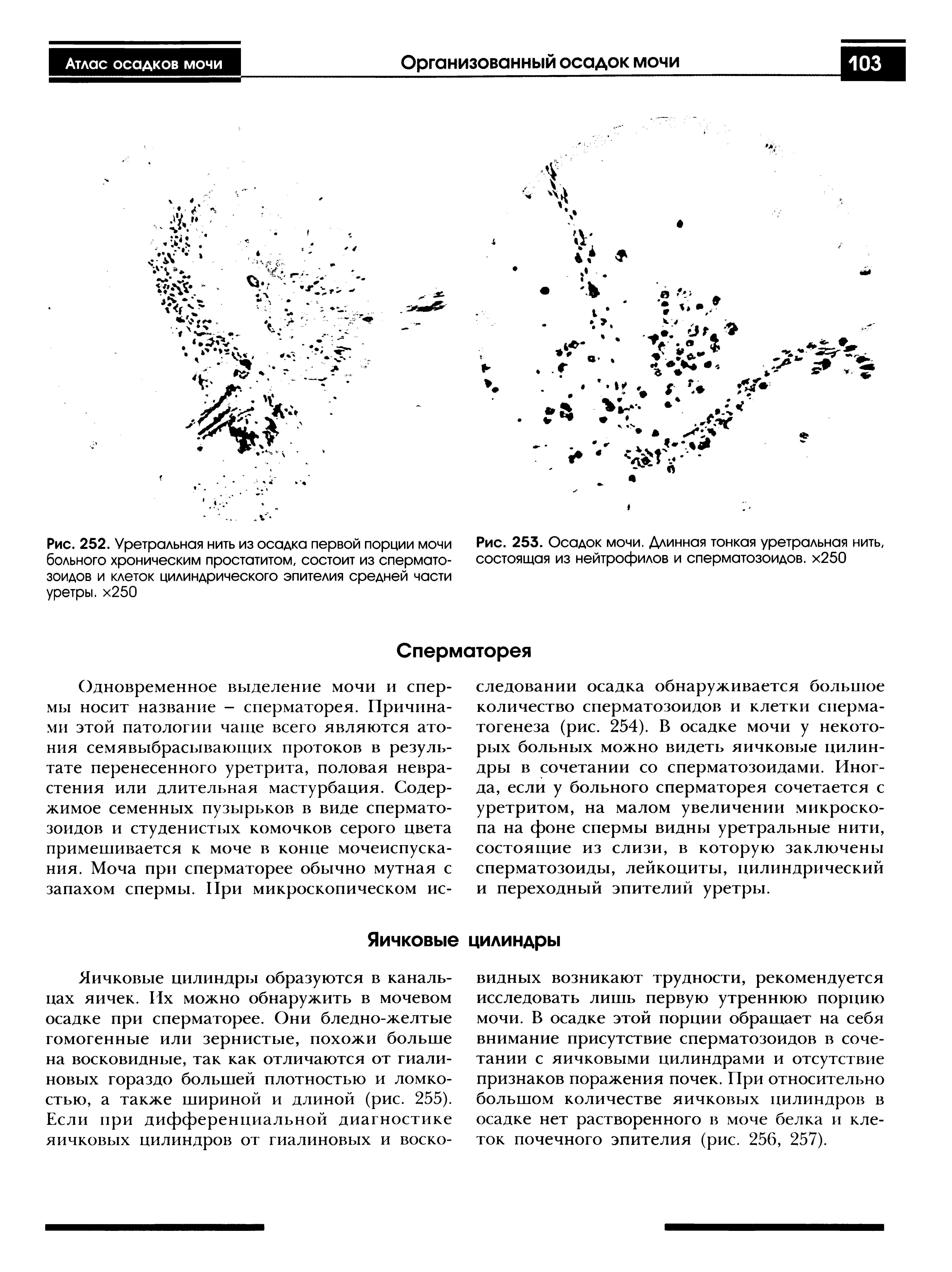 Рис. 253. Осадок мочи. Длинная тонкая уретральная нить, состоящая из нейтрофилов и сперматозоидов. х250...