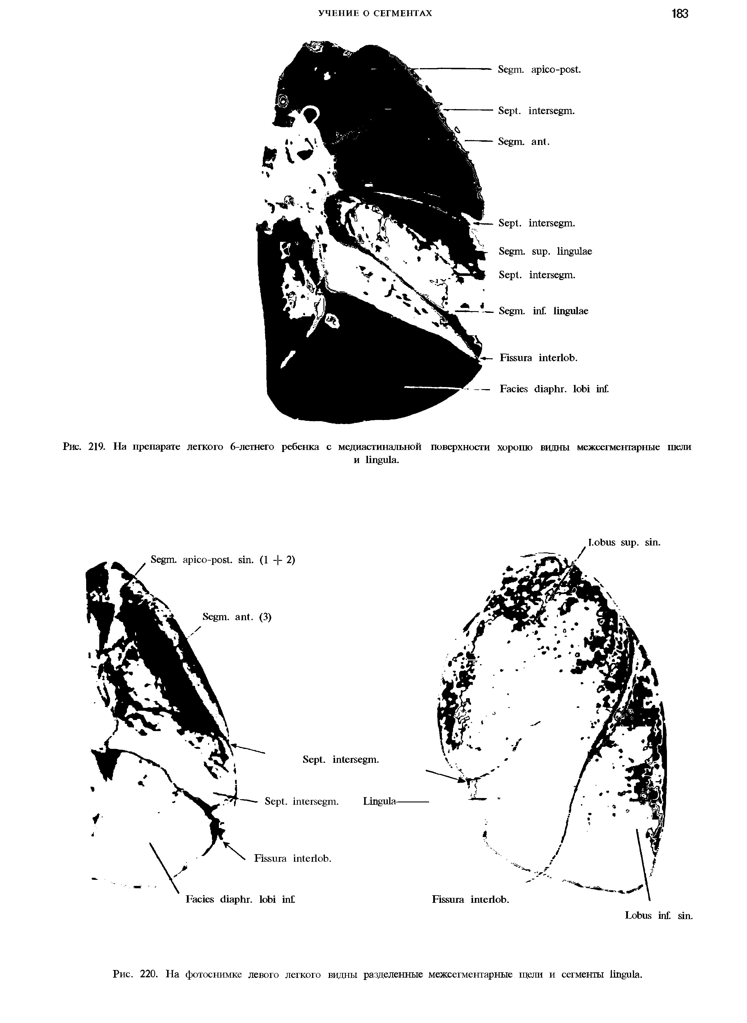 Рис. 220. На фотоснимке левого легкого видны разделенные межсегментарные щели и сегменты .