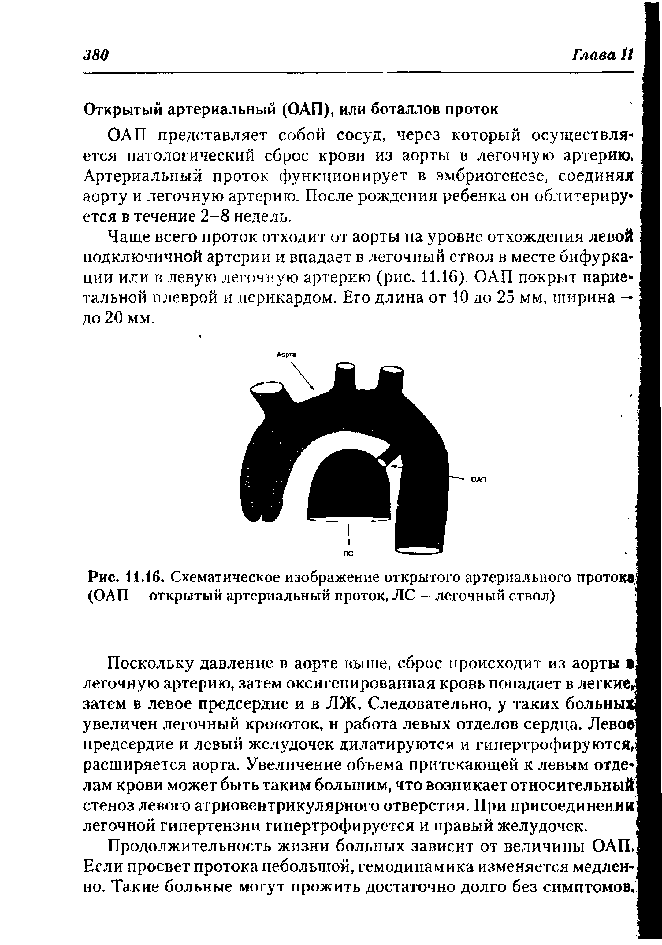 Рис. 11.16. Схематическое изображение открытого артериального протока, (ОАП — открытый артериальный проток, ЛС — легочный ствол)...