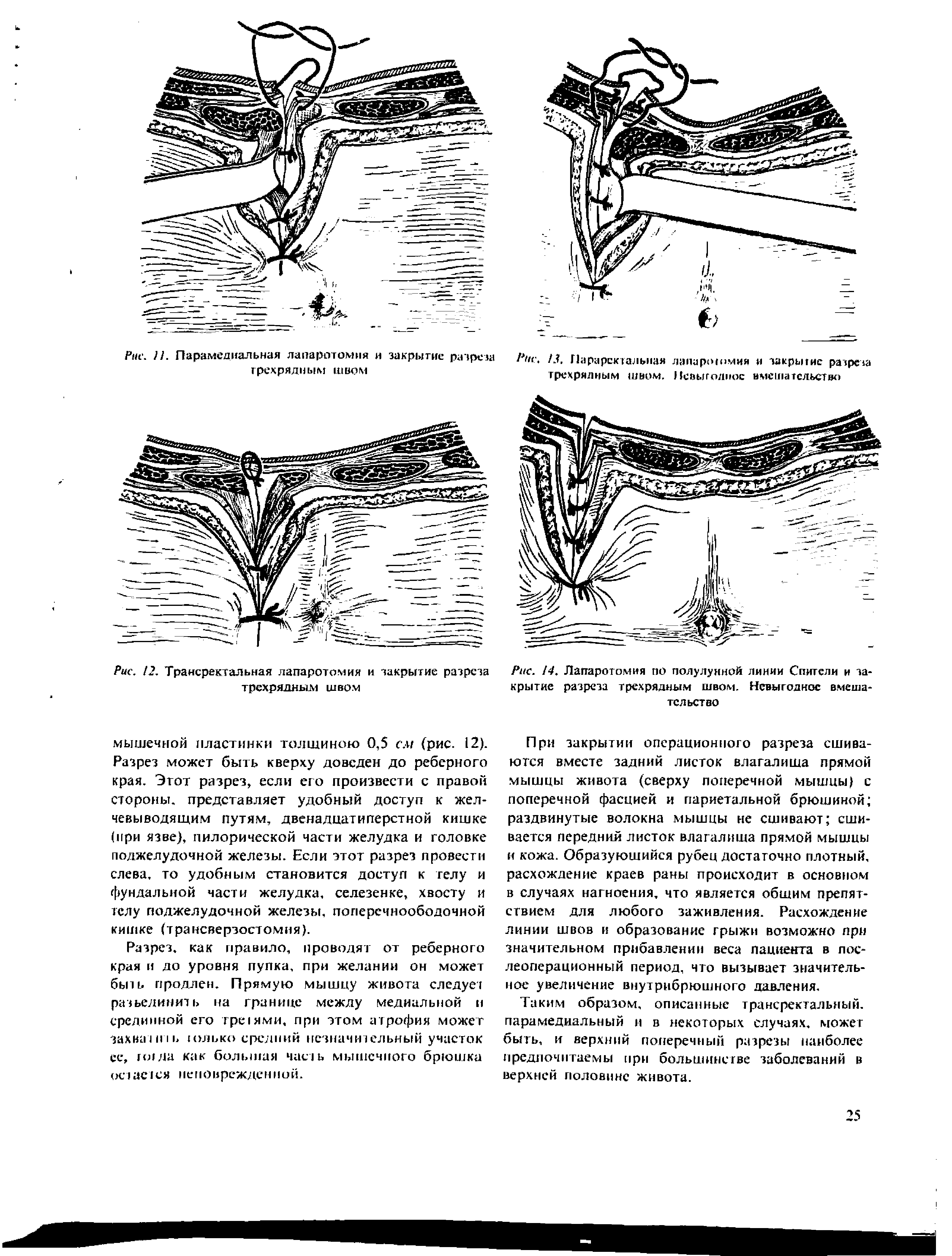 Рис. /4. Лапаротомия по полулунной линии Спители и закрытие разреза трех рядным швом. Невыгодное вмешательство...