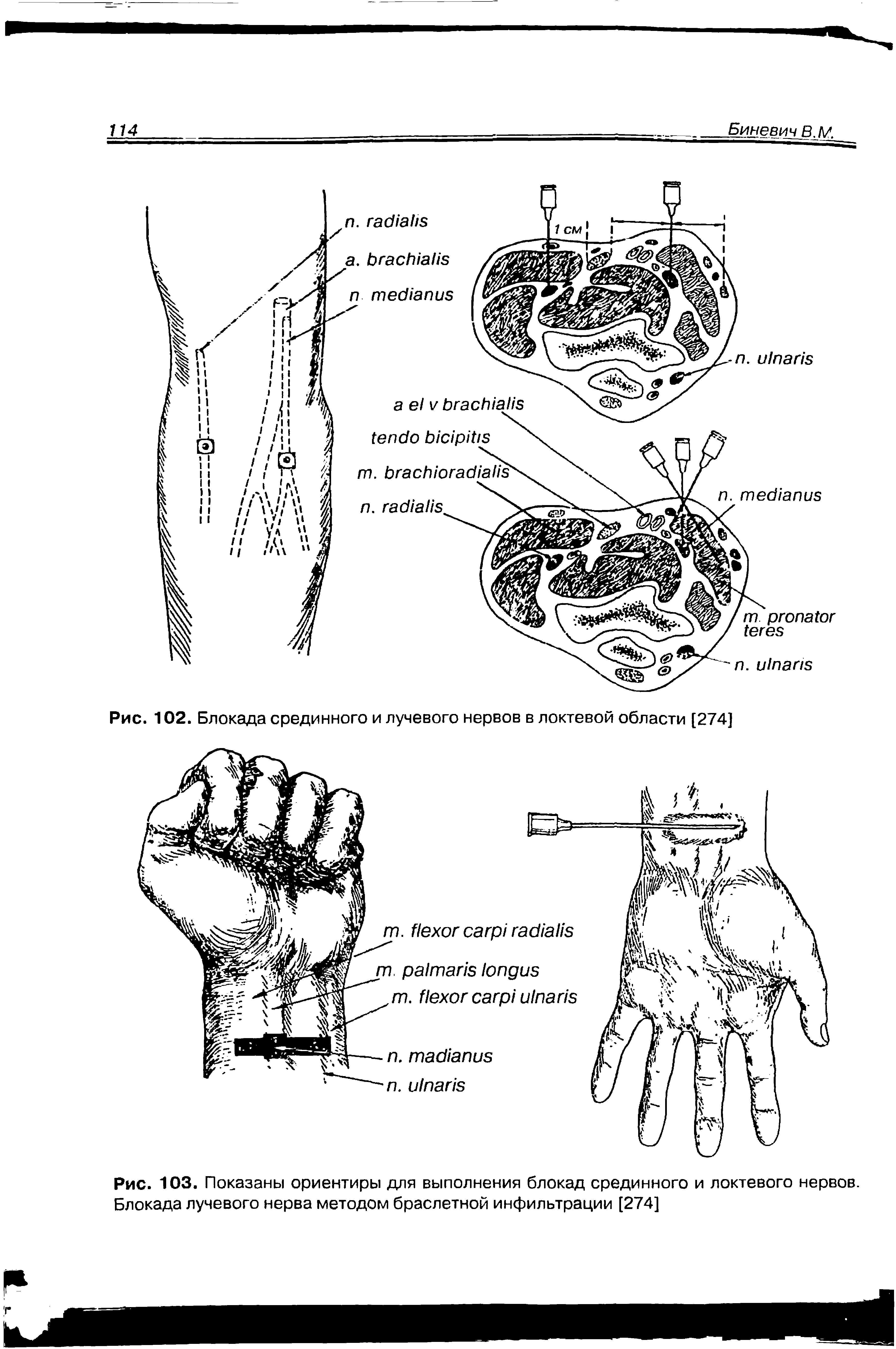 Рис. 103. Показаны ориентиры для выполнения блокад срединного и локтевого нервов. Блокада лучевого нерва методом браслетной инфильтрации [274]...