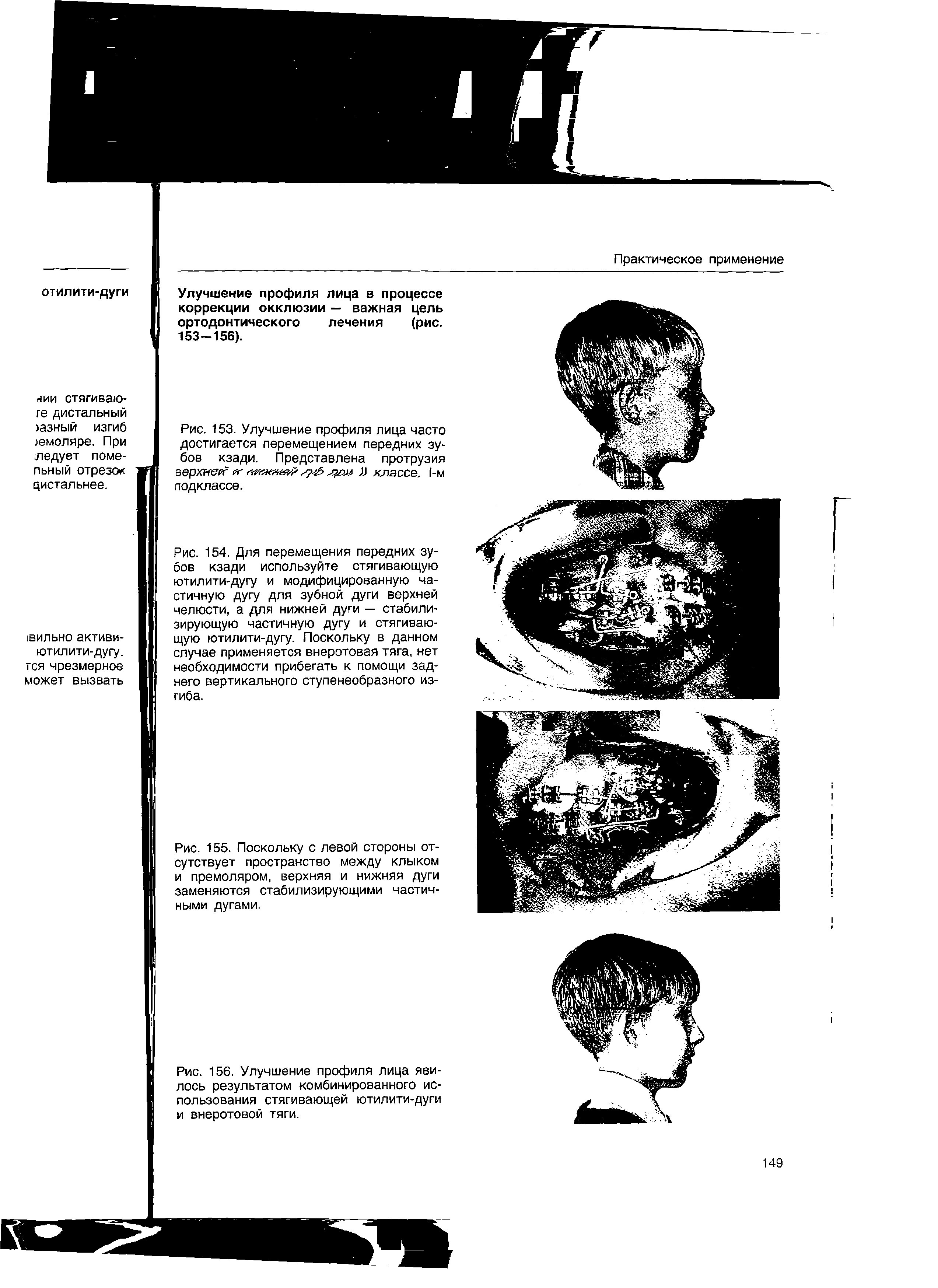 Рис. 156. Улучшение профиля лица явилось результатом комбинированного использования стягивающей ютилити-дуги и внеротовой тяги.