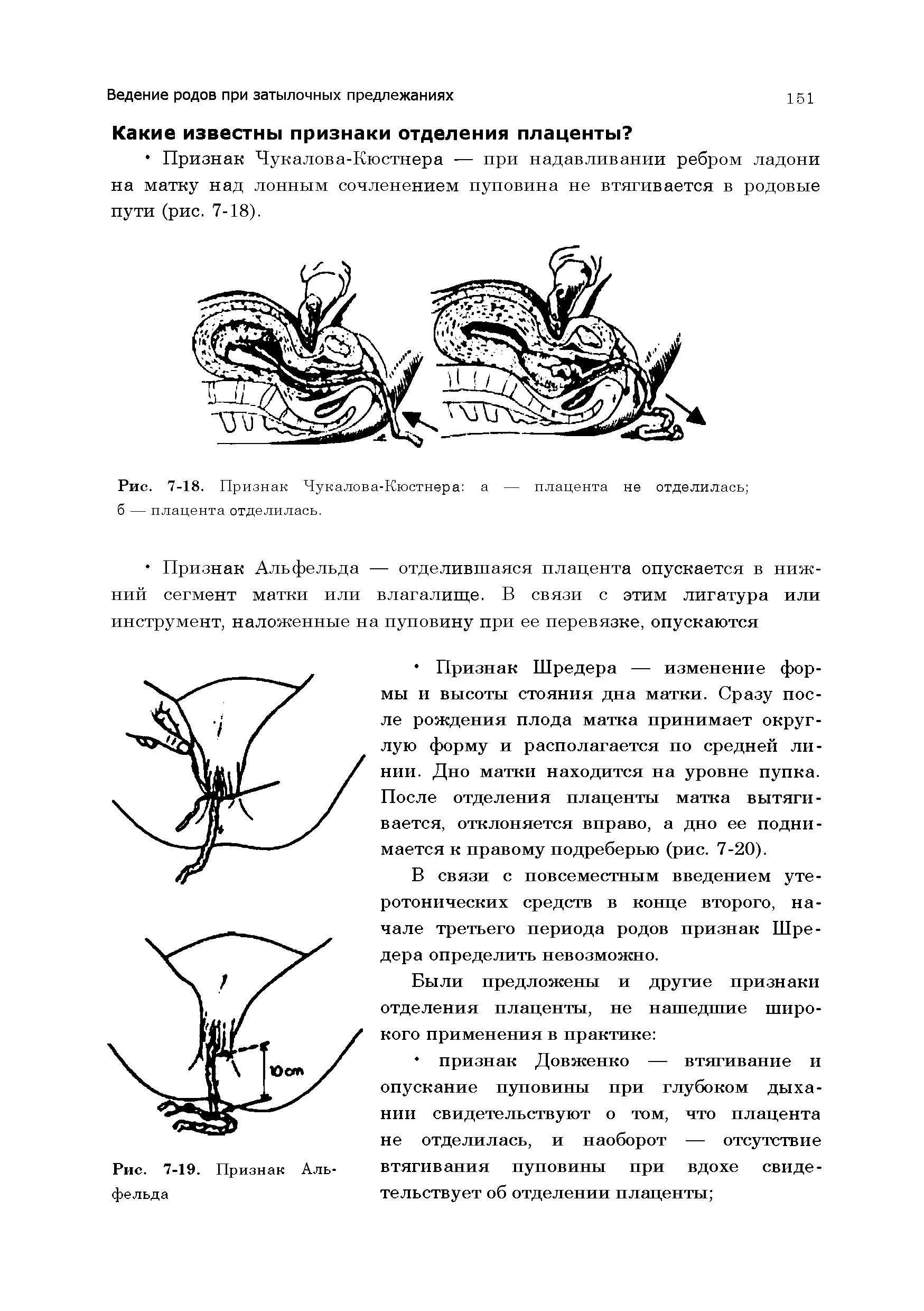 Рис. 7-18. Признак Чукалова-Кюстнера а — плацента не отделилась б — плацента отделилась.