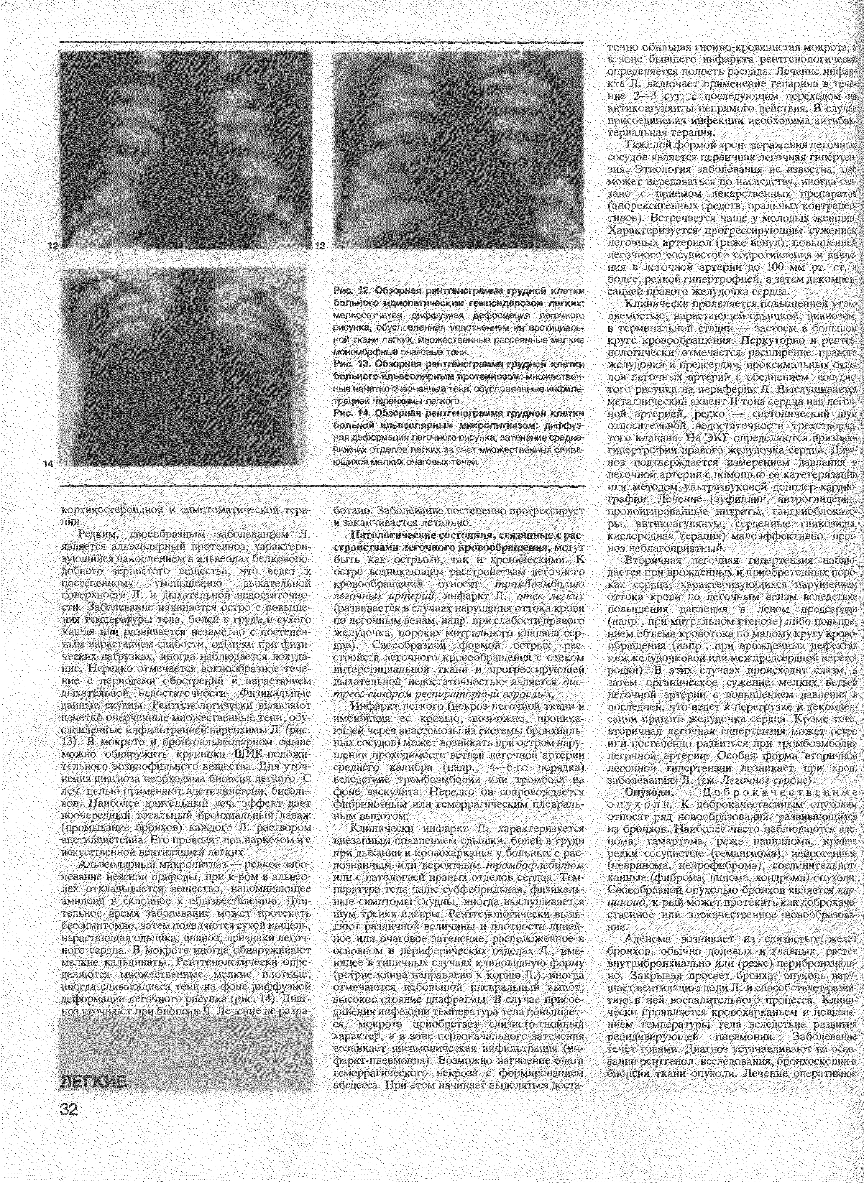 Рис. 12. Обзорная рентгенограмма грудной клетки больного идиопатическим гемосидерозом легких ме мыл ли /иффу го дзфор , зи7. г-го...