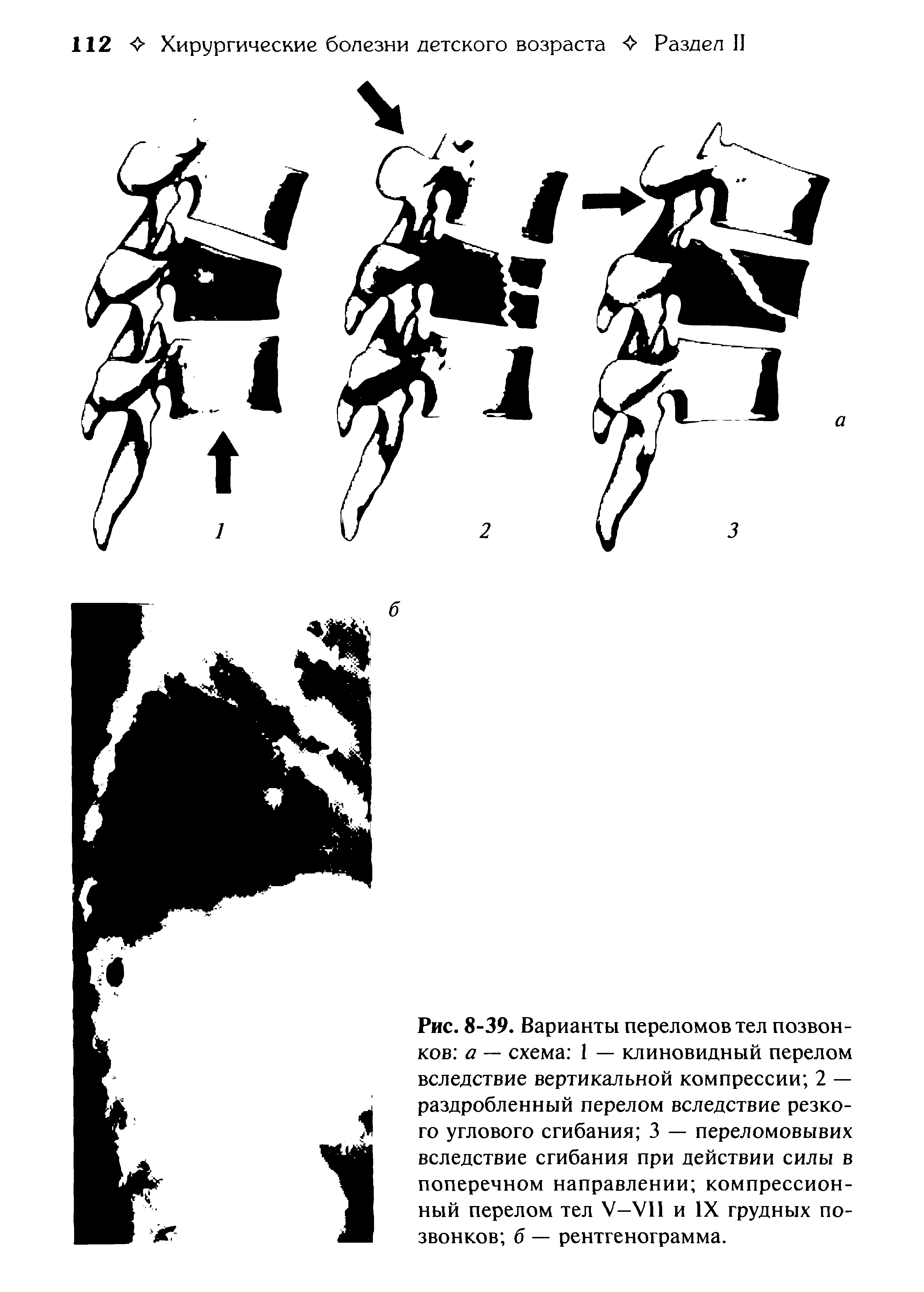 Рис. 8-39. Варианты переломов тел позвонков а — схема 1 — клиновидный перелом вследствие вертикальной компрессии 2 — раздробленный перелом вследствие резкого углового сгибания 3 — переломовывих вследствие сгибания при действии силы в поперечном направлении компрессионный перелом тел У-У11 и IX грудных позвонков б — рентгенограмма.