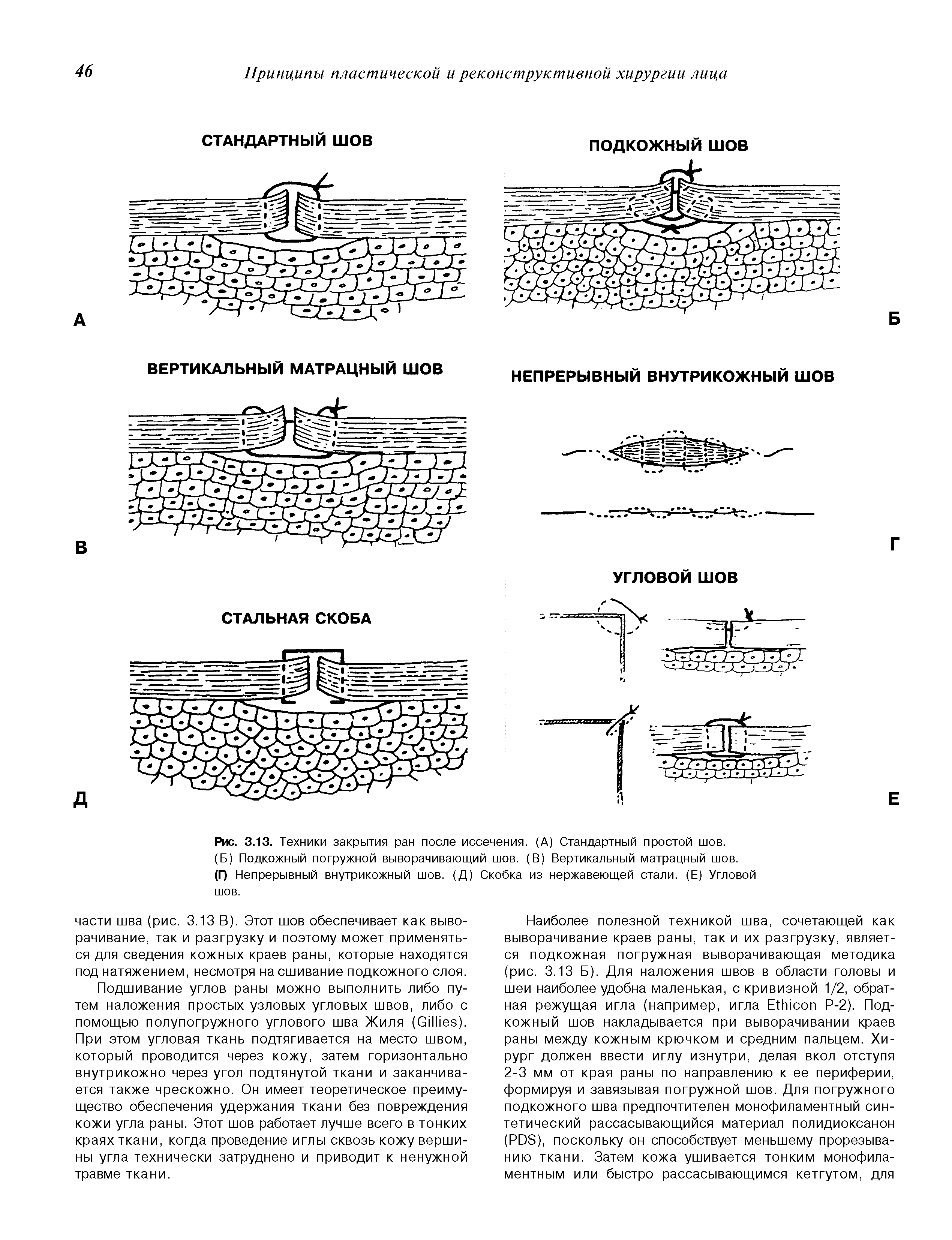 Рис. 3.13. Техники закрытия ран после иссечения. (А) Стандартный простой шов. (Б) Подкожный погружной выворачивающий шов. (В) Вертикальный матрацный шов. (Г) Непрерывный внутрикожный шов. (Д) Скобка из нержавеющей стали. (Е) Угловой шов.