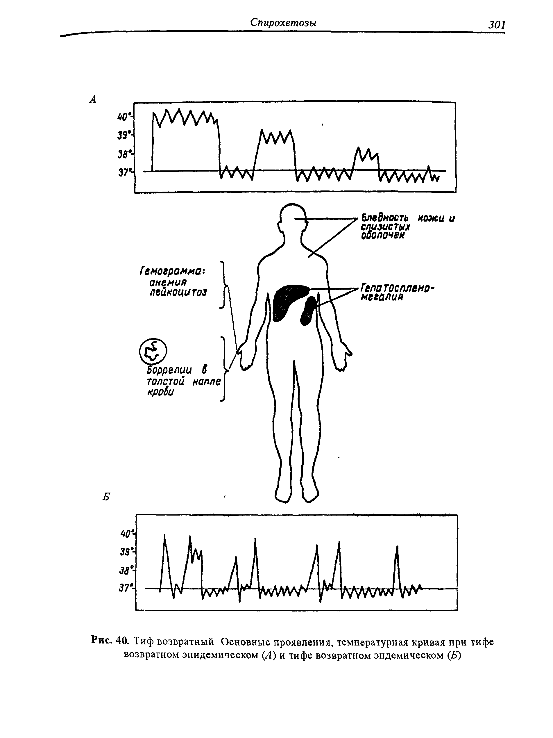 Рис. 40. Тиф возвратный Основные проявления, температурная кривая при тифе возвратном эпидемическом (Л) и тифе возвратном эндемическом (Б)...