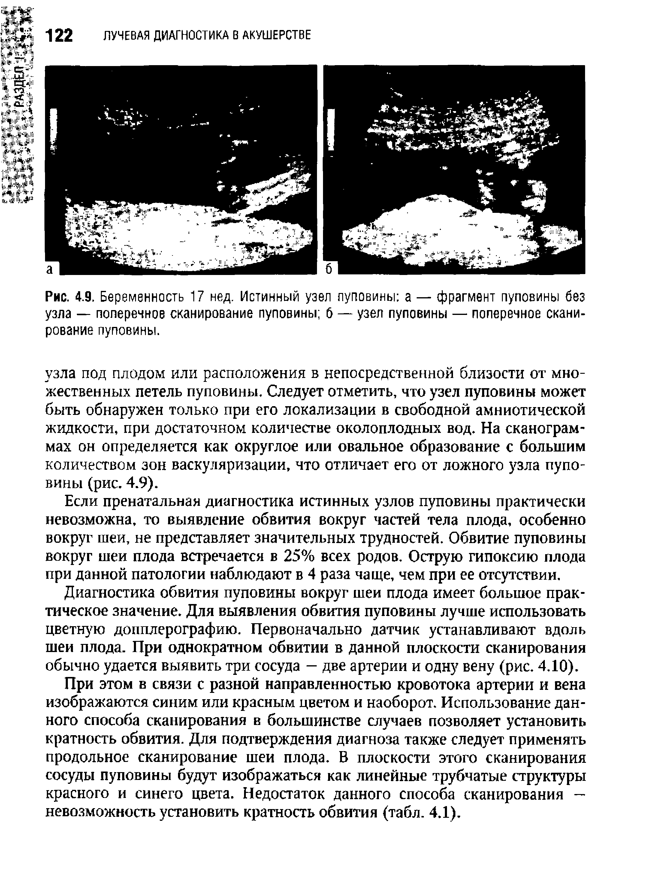 Рис. 4.9. Беременность 17 нед. Истинный узел пуповины а — фрагмент пуповины без узла — поперечное сканирование пуповины б — узел пуповины — поперечное сканирование пуповины.