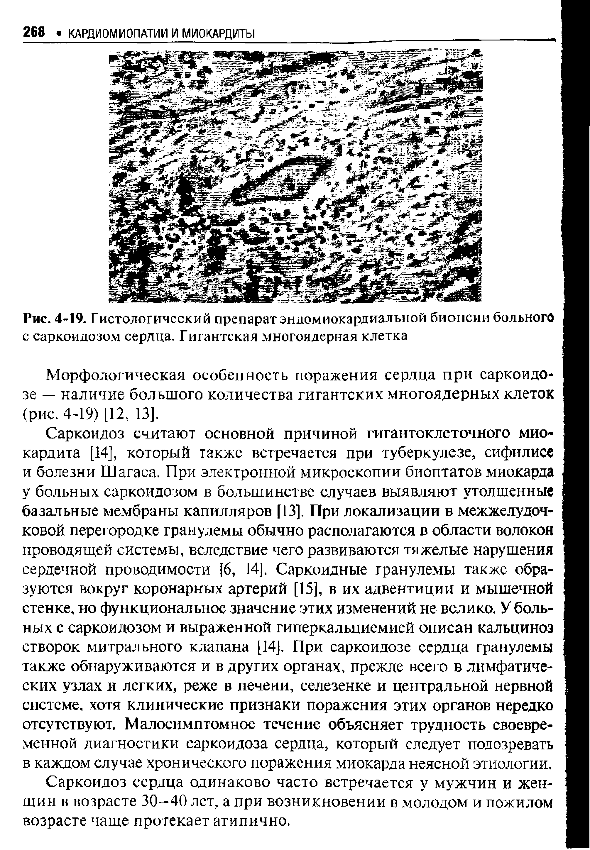 Рис. 4-19. Гистологический препарат эндомиокардиальной биопсии больного с саркоидозом сердца. Гигантская многоядерная клетка...