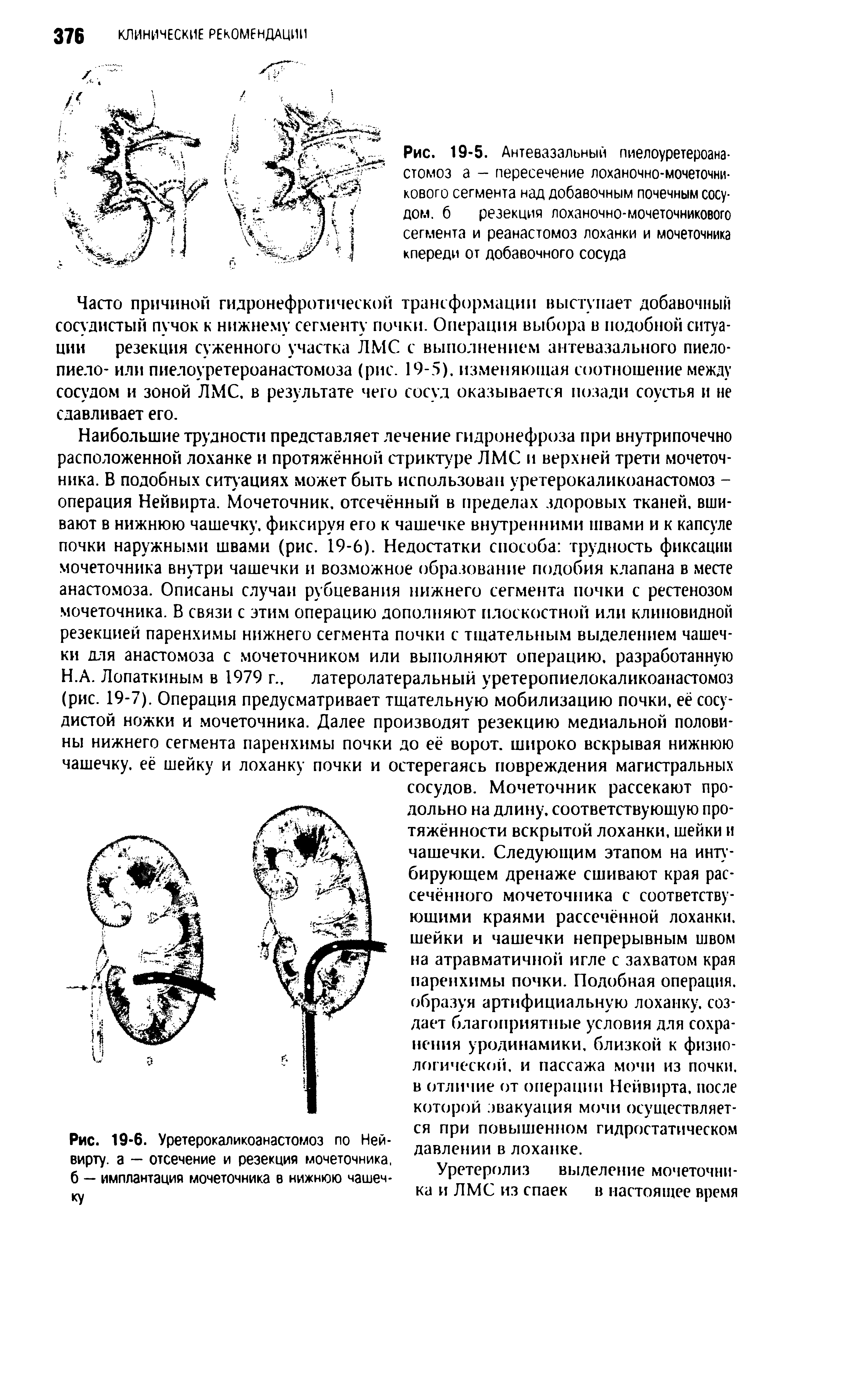 Рис. 19-5. Антевазальный пиелоуретероана-стомоз а - пересечение лоханочно-мочеточникового сегмента над добавочным почечным сосудом. 6 резекция лоханочно-мочеточникового сегмента и реанастомоз лоханки и мочеточника кпереди от добавочного сосуда...