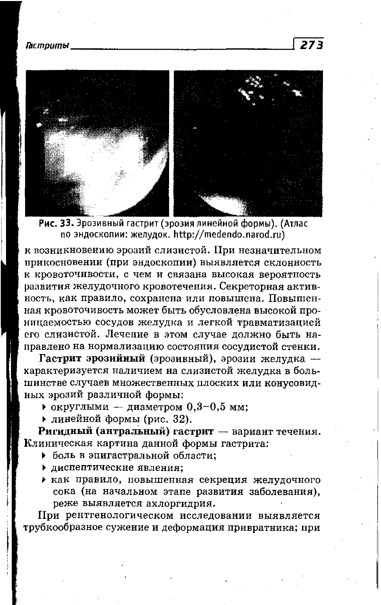 Рис. 33. Эрозивный гастрит (эрозия линейной формы). (Атлас по эндоскопии желудок, // . . )...