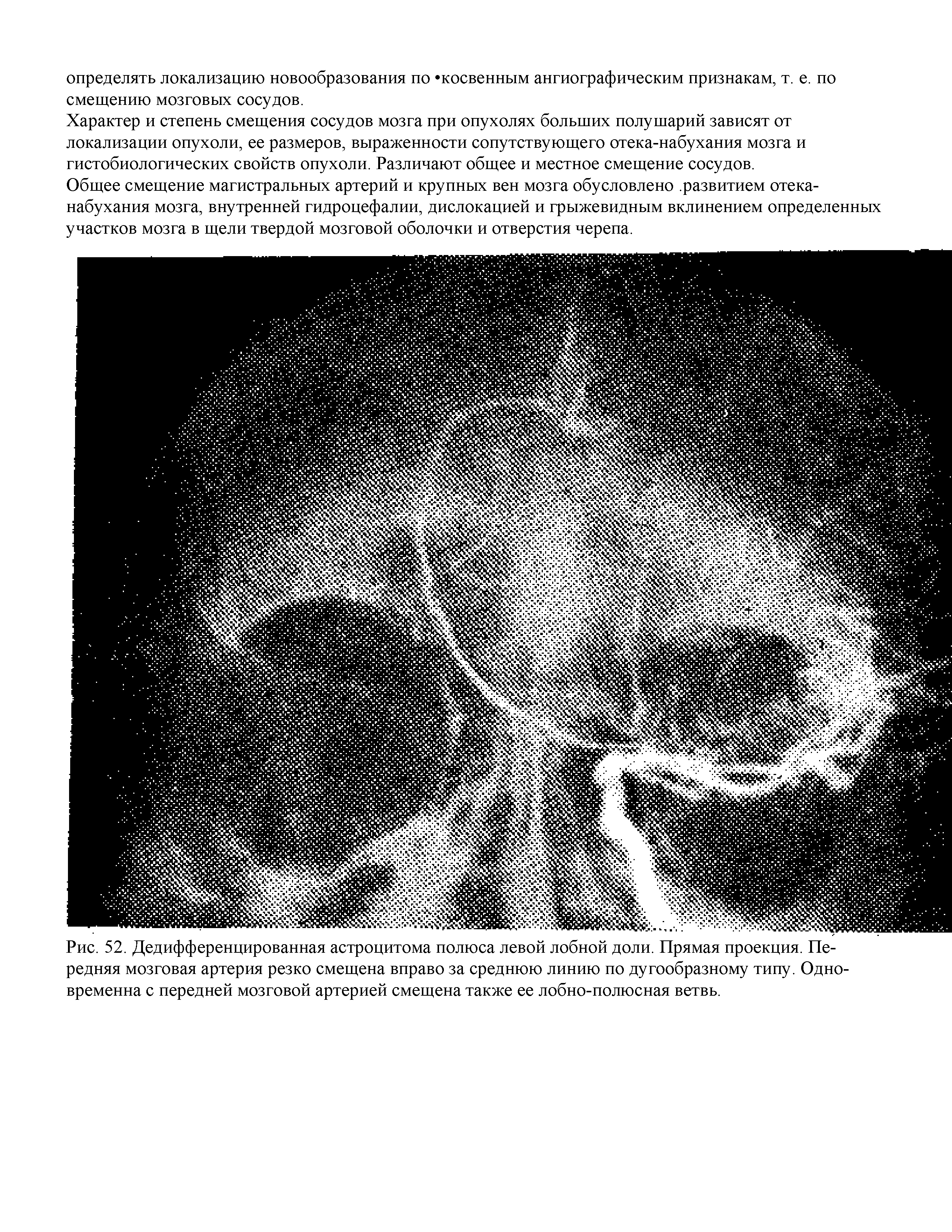 Рис. 52. Дедифференцированная астроцитома полюса левой лобной доли. Прямая проекция. Передняя мозговая артерия резко смещена вправо за среднюю линию по дугообразному типу. Одновременна с передней мозговой артерией смещена также ее лобно-полюсная ветвь.