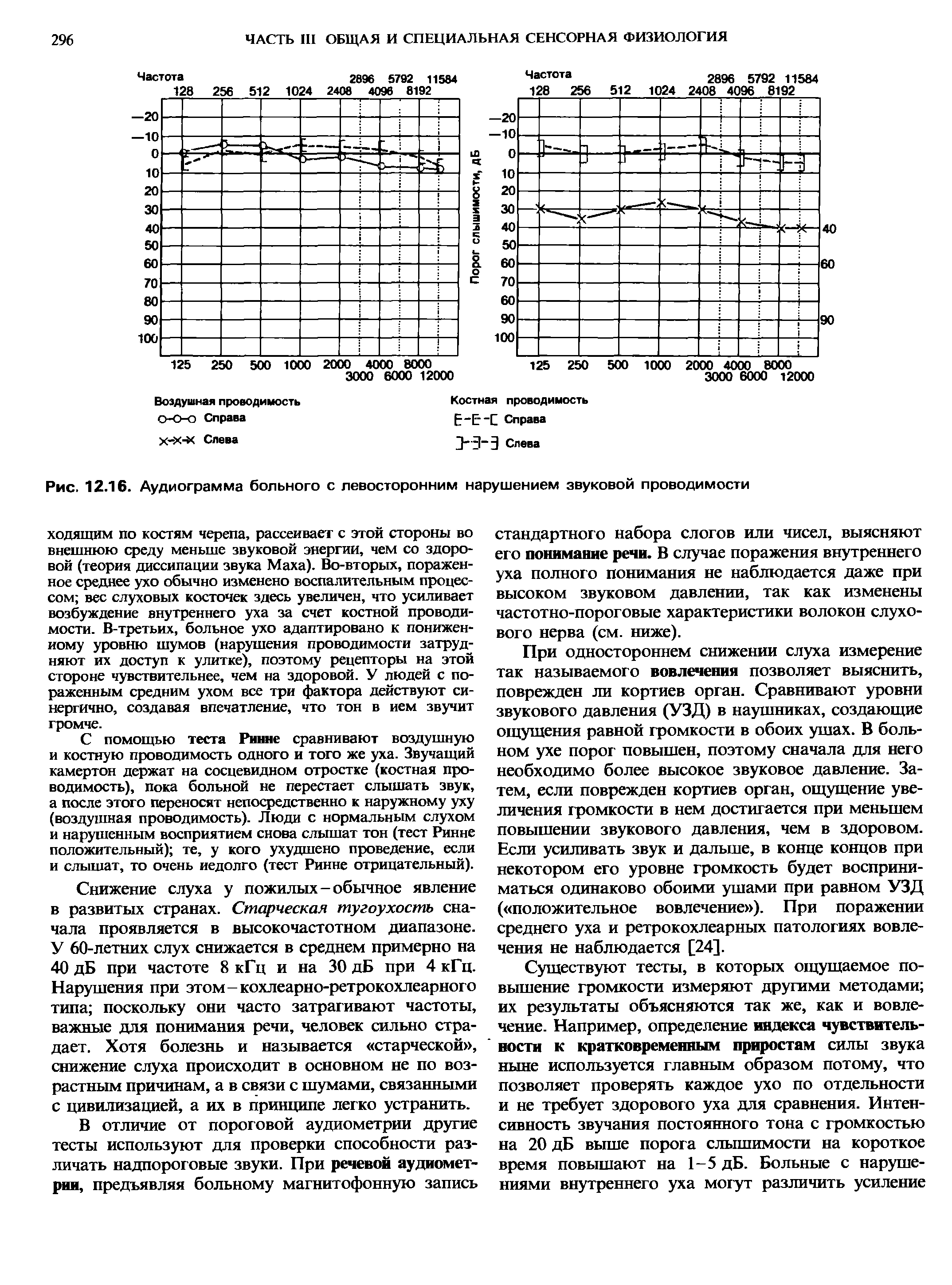 Рис. 12.16. Аудиограмма больного с левосторонним нарушением звуковой проводимости...