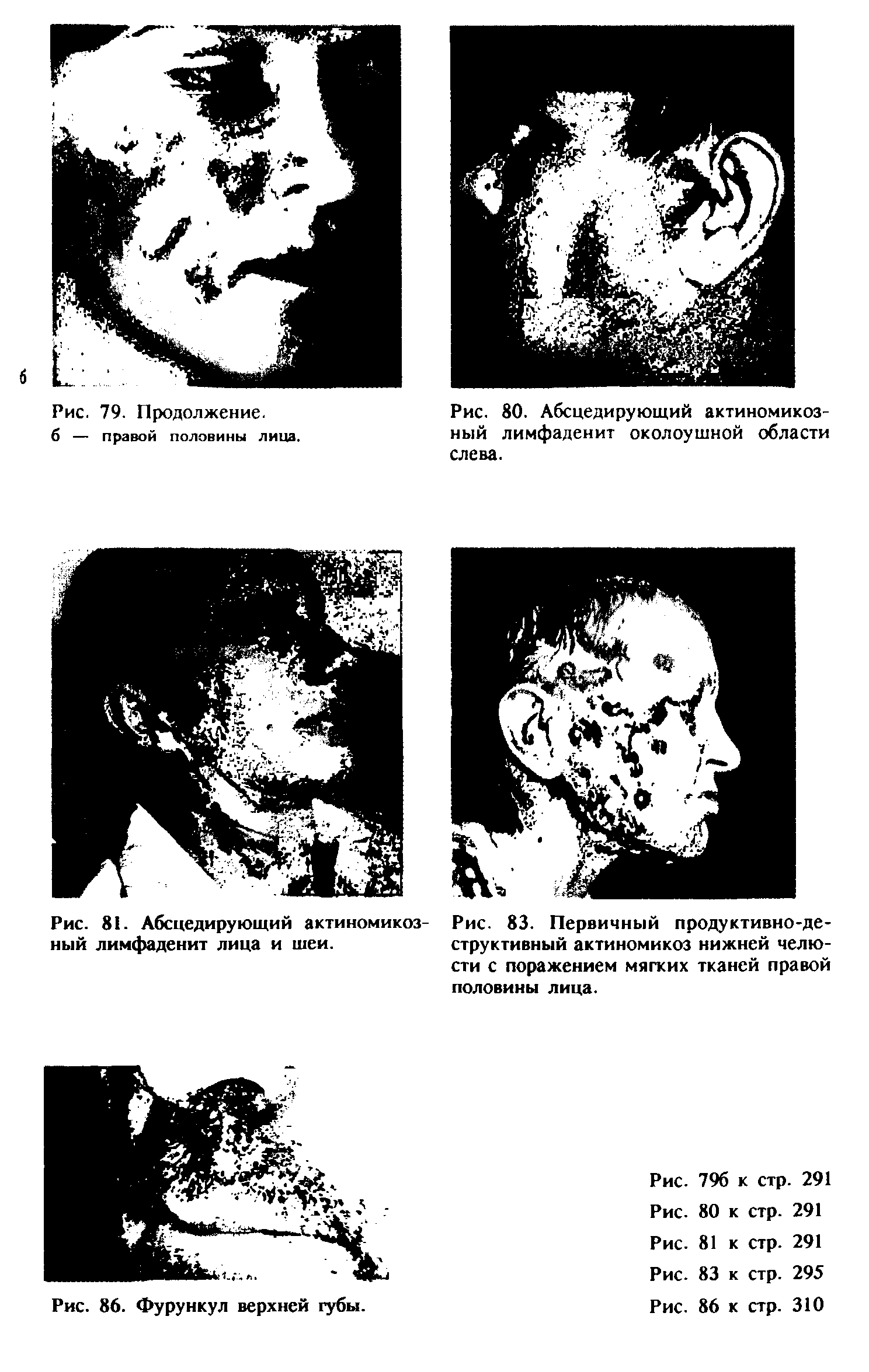 Рис. 80. Абсцедирующий актиномикозный лимфаденит околоушной области слева.