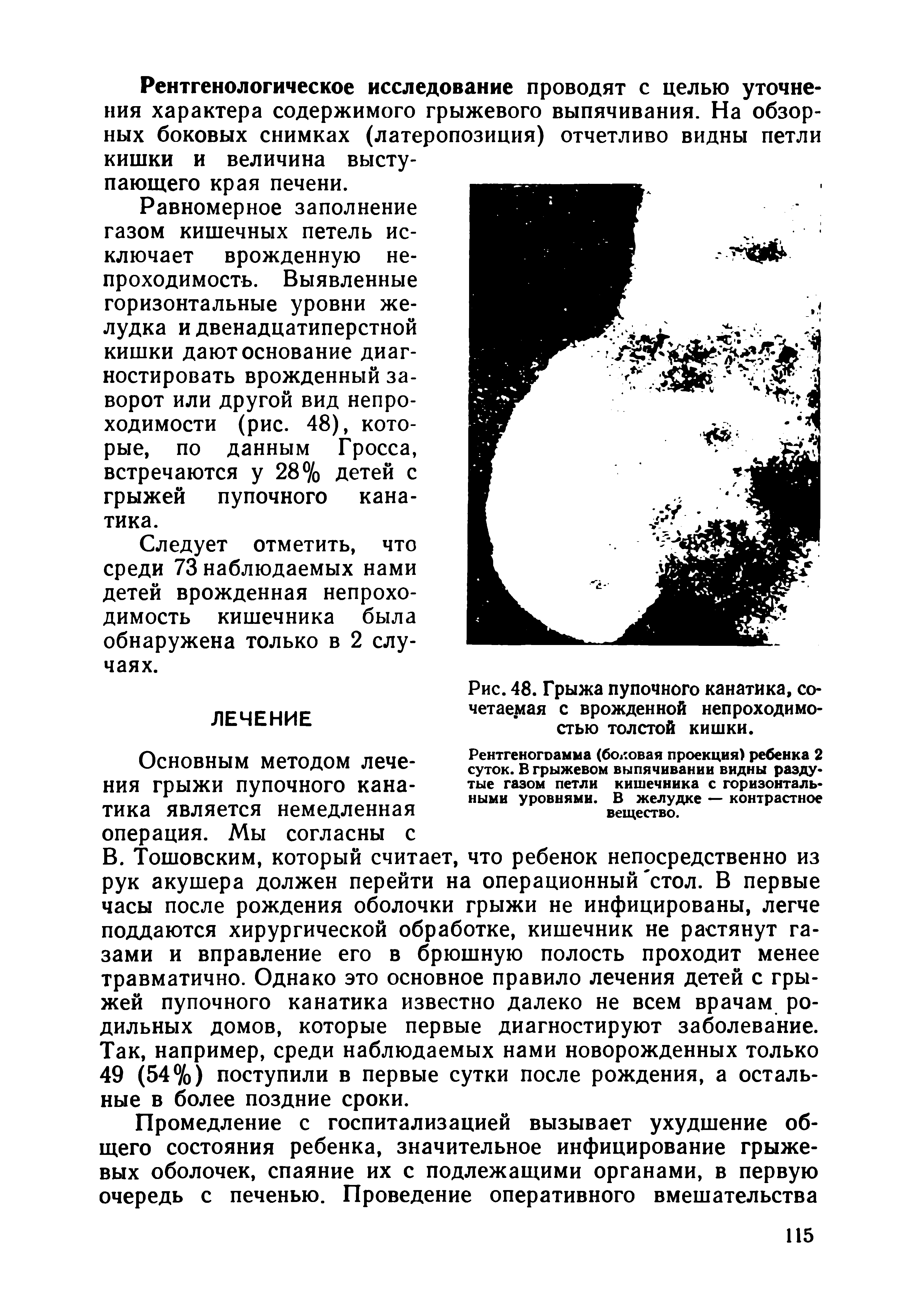 Рис. 48. Грыжа пупочного канатика, сочетаемая с врожденной непроходимостью толстой кишки.